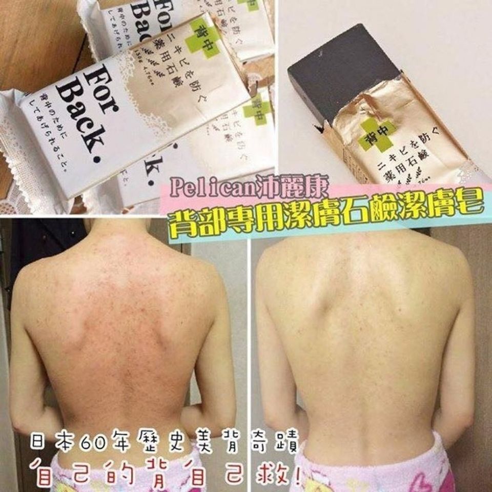 [TIPS] Những cách giúp đánh bật mụn lưng từ vài tháng đến vài tuần
