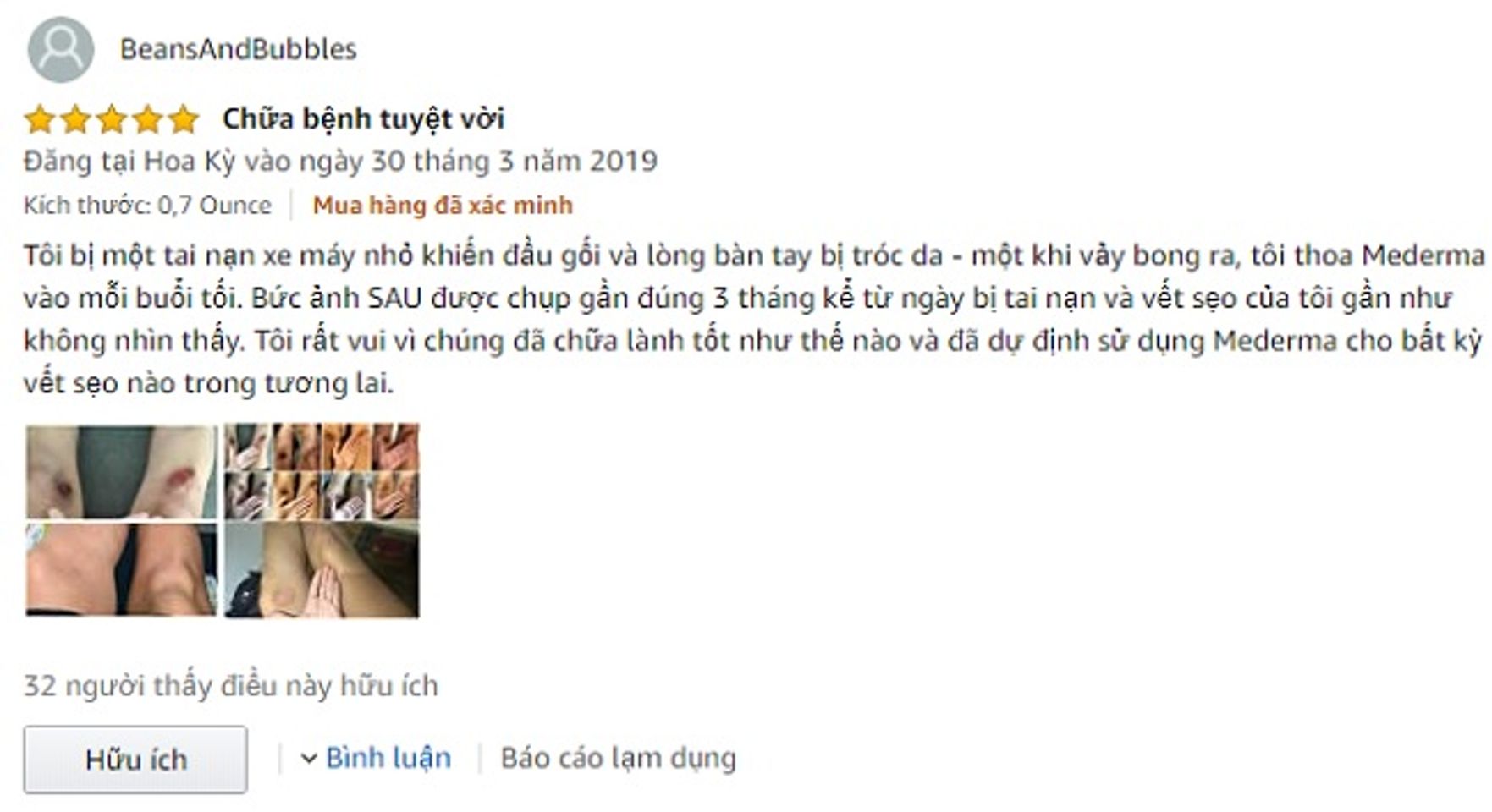 Mederma Advanced Scar Gel Reviews từ người sử dụng 2