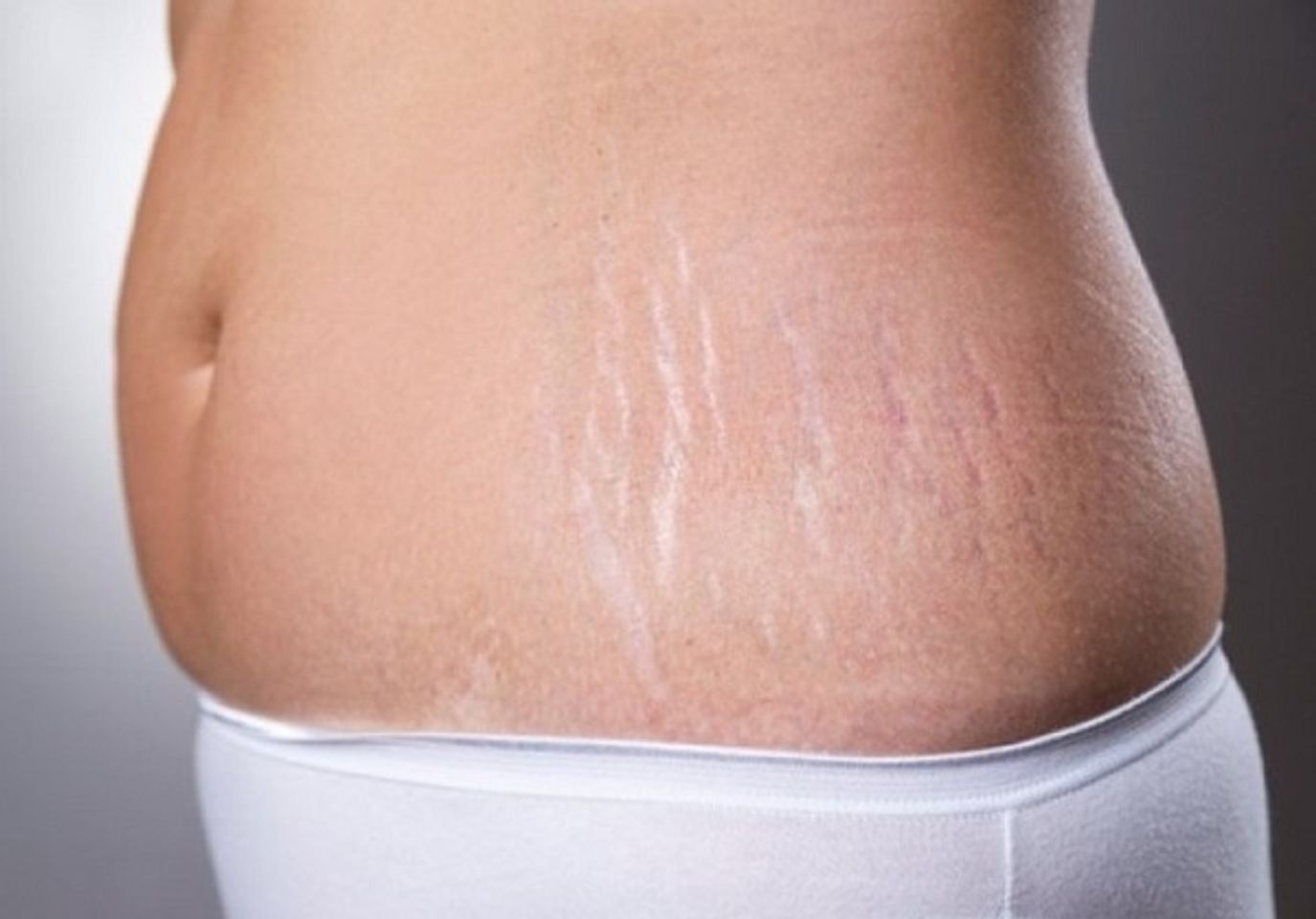 kem Bio Oil trị rạn da cho b&agrave; bầu
