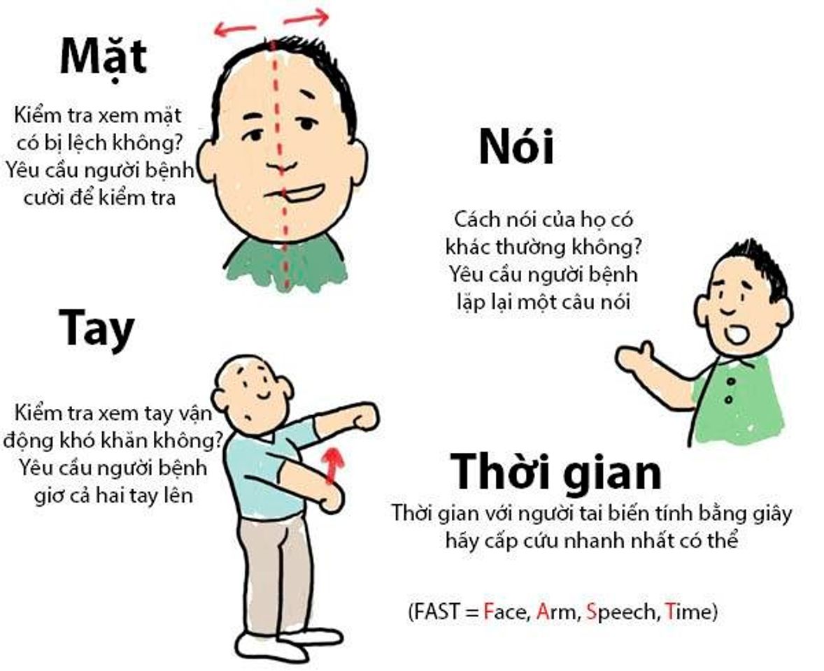 quy tắc F.A.S.T ph&aacute;t hiện nguy cơ đột quỵ 