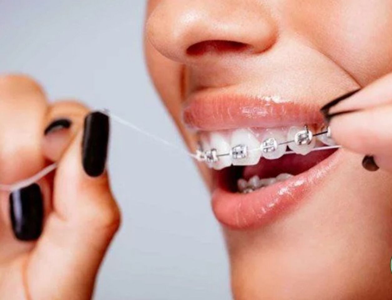 C&aacute;ch d&ugrave;ng chỉ nha khoa cho người niềng răng