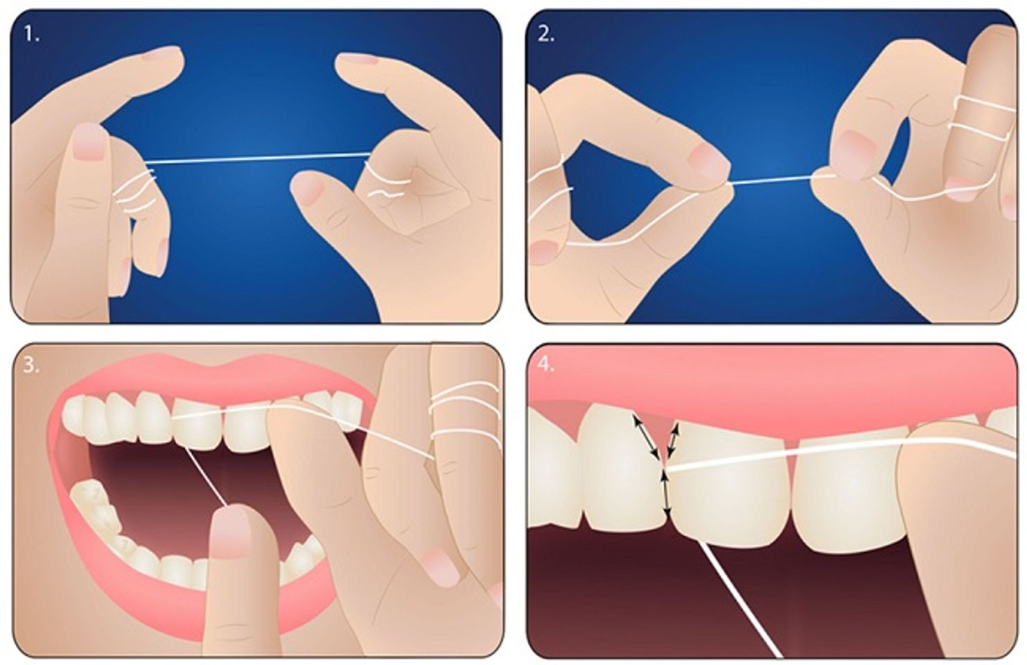 C&aacute;ch sử dụng chỉ nha khoa truyền thống