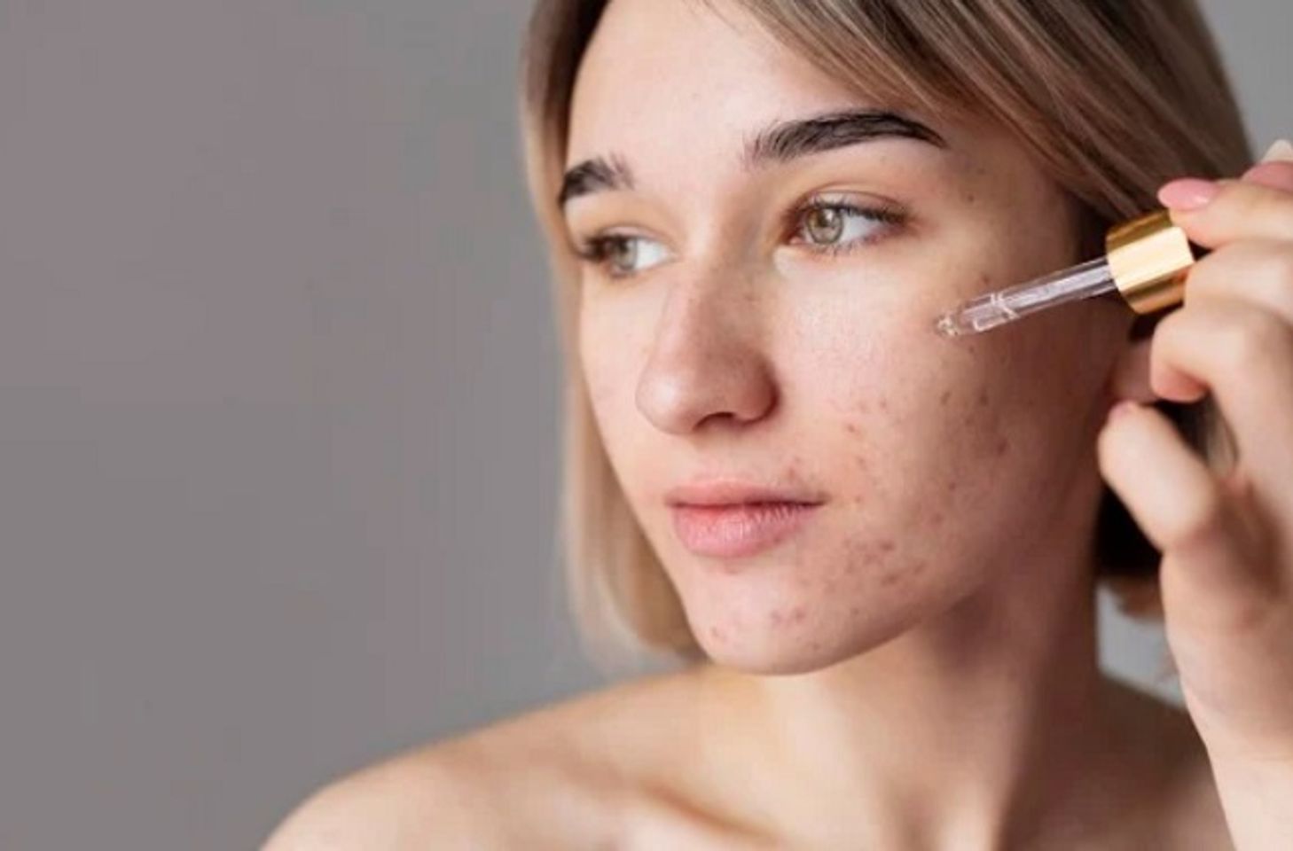 Lactic acid gi&uacute;p ngăn ngừa v&agrave; cải thiện mụn trứng c&aacute;