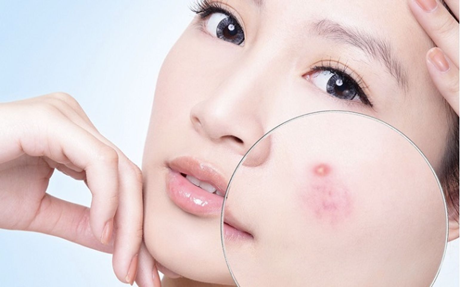 Salicylic acid tốt cho da dầu mụn
