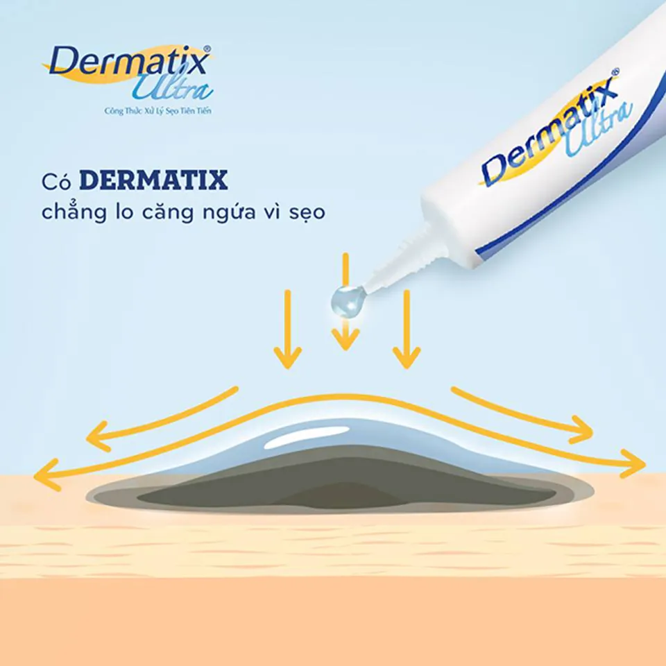 Dermatix Ultra Gel hỗ trợ mọi vấn đề về sẹo hiệu quả
