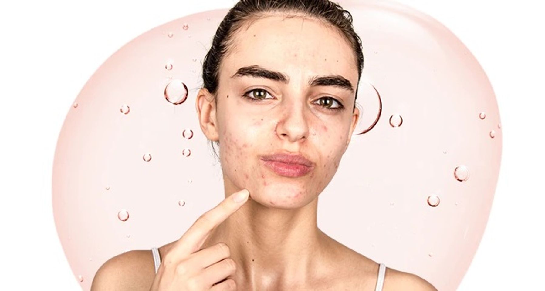 Serum trị mụn c&oacute; ưu điểm g&igrave;