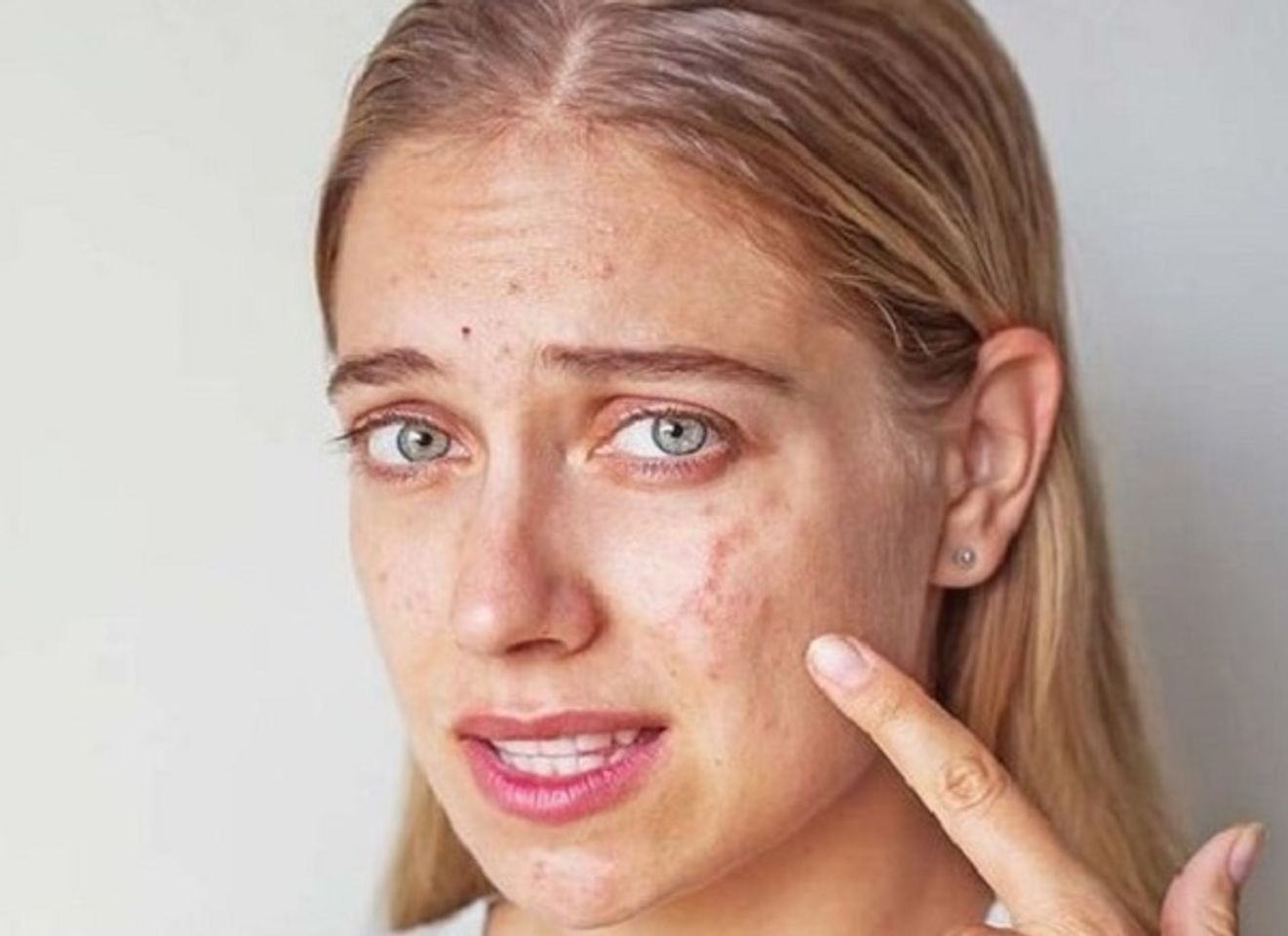 ưu điểm của peel da trị mụn