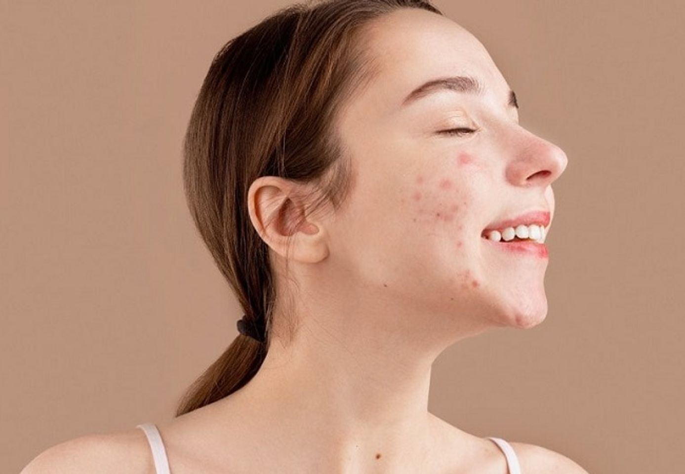 PHA gi&uacute;p trị mụn trứng c&aacute;