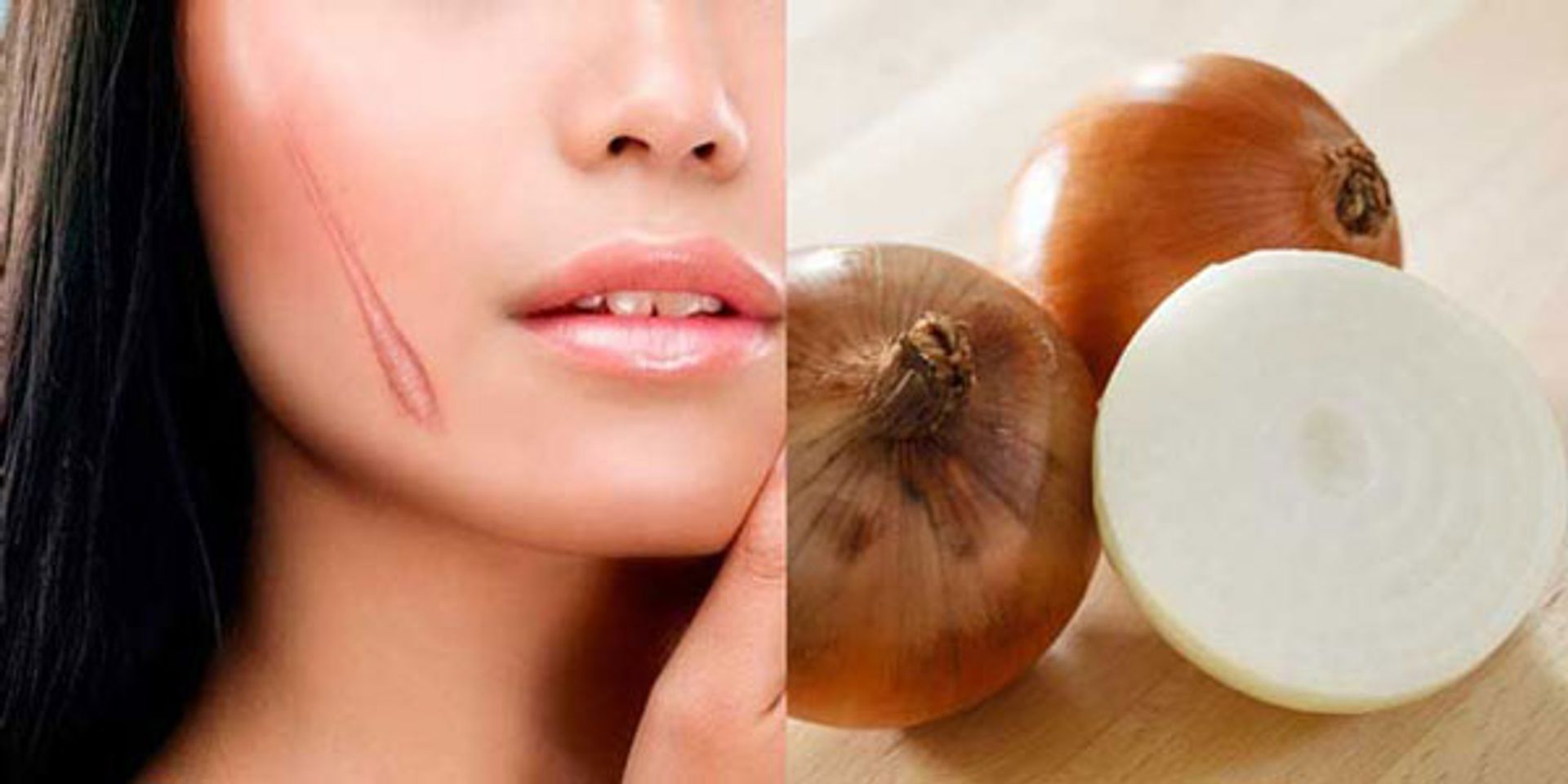 c&aacute;ch trị sẹo tại nh&agrave; bằng h&agrave;nh t&acirc;y