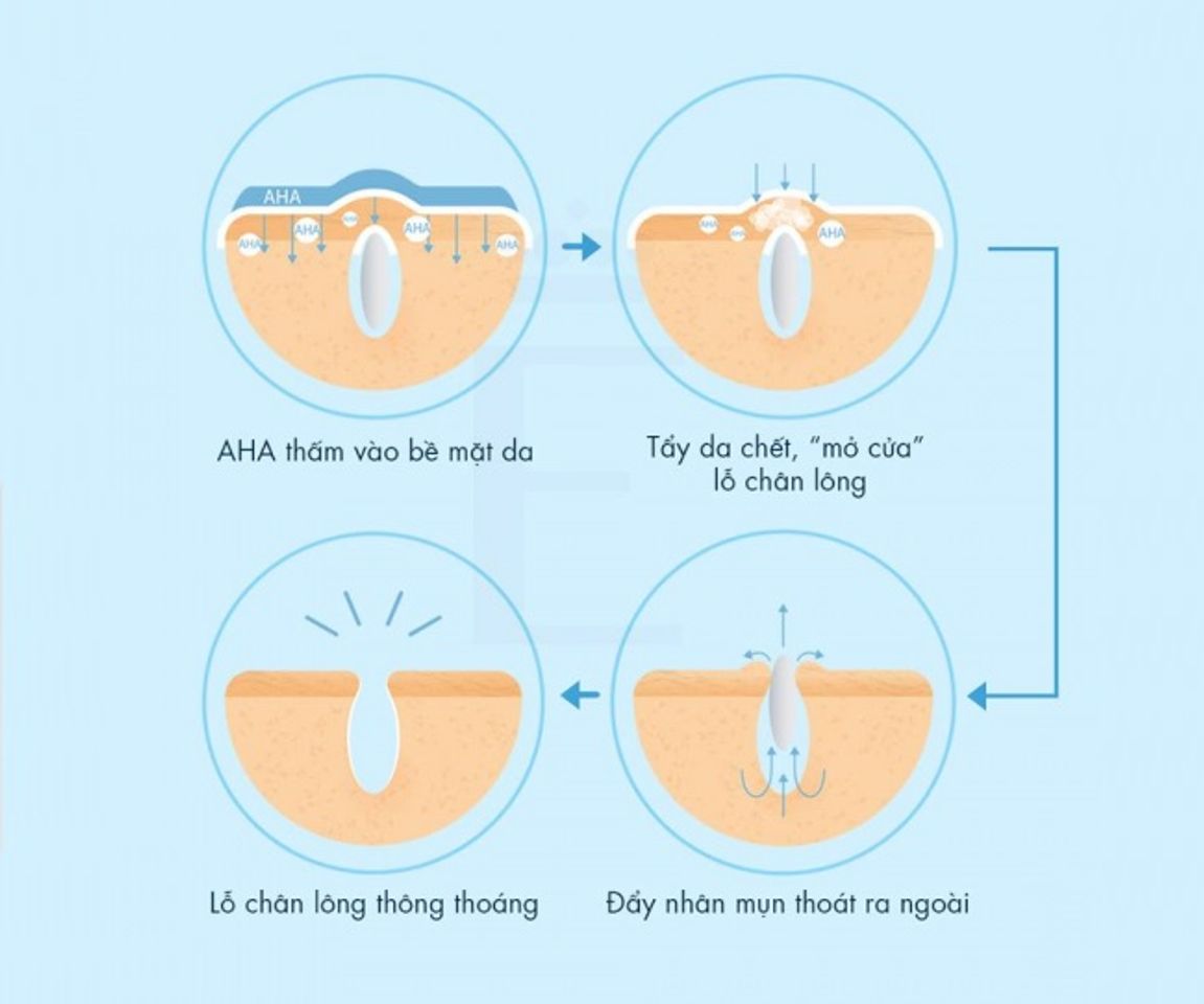 C&aacute;c loại treatment - AHA
