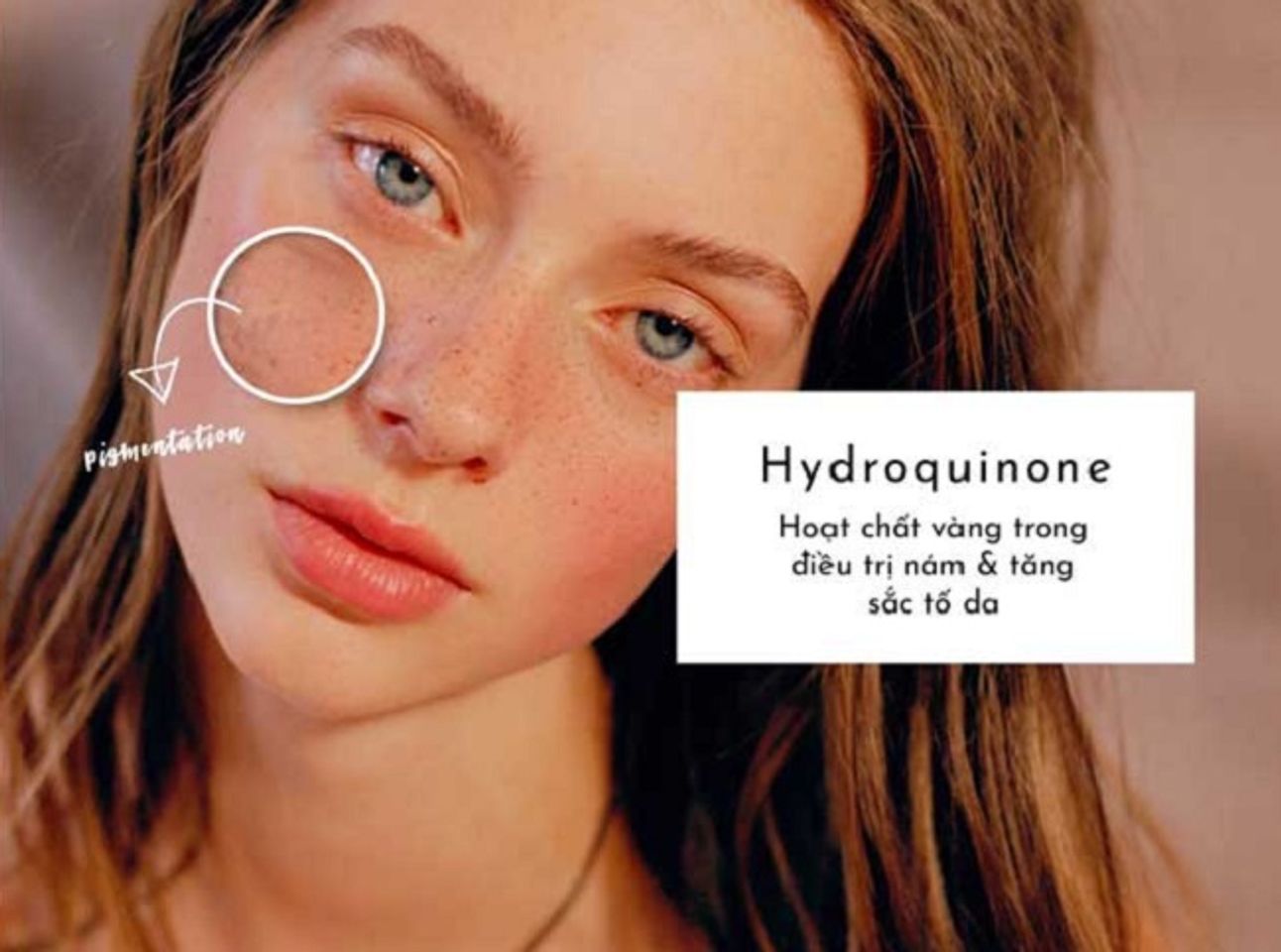 C&aacute;c loại Treatment - Hydroquinone