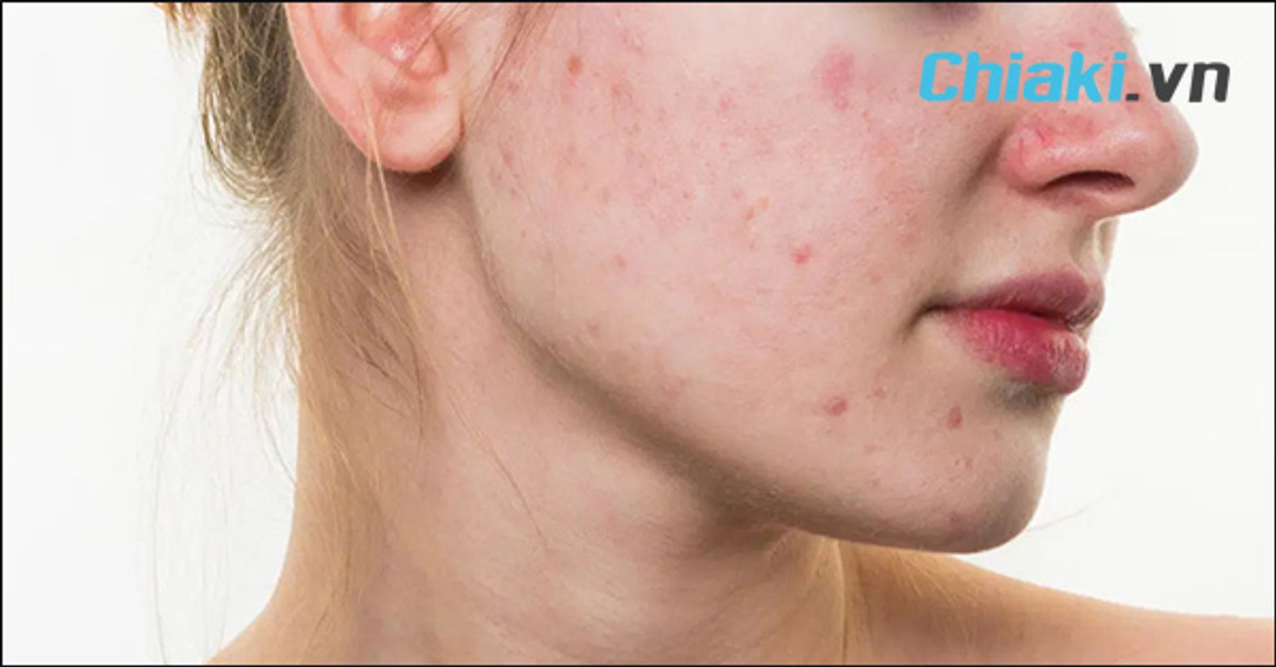 M&aacute;y rửa mặt bị nấm mốc sẽ khiến da dễ nổi mụn