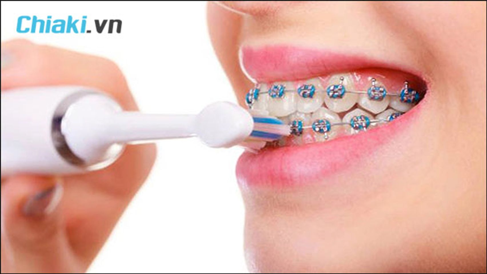 niềng răng c&oacute; n&ecirc;n d&ugrave;ng b&agrave;n chải điện