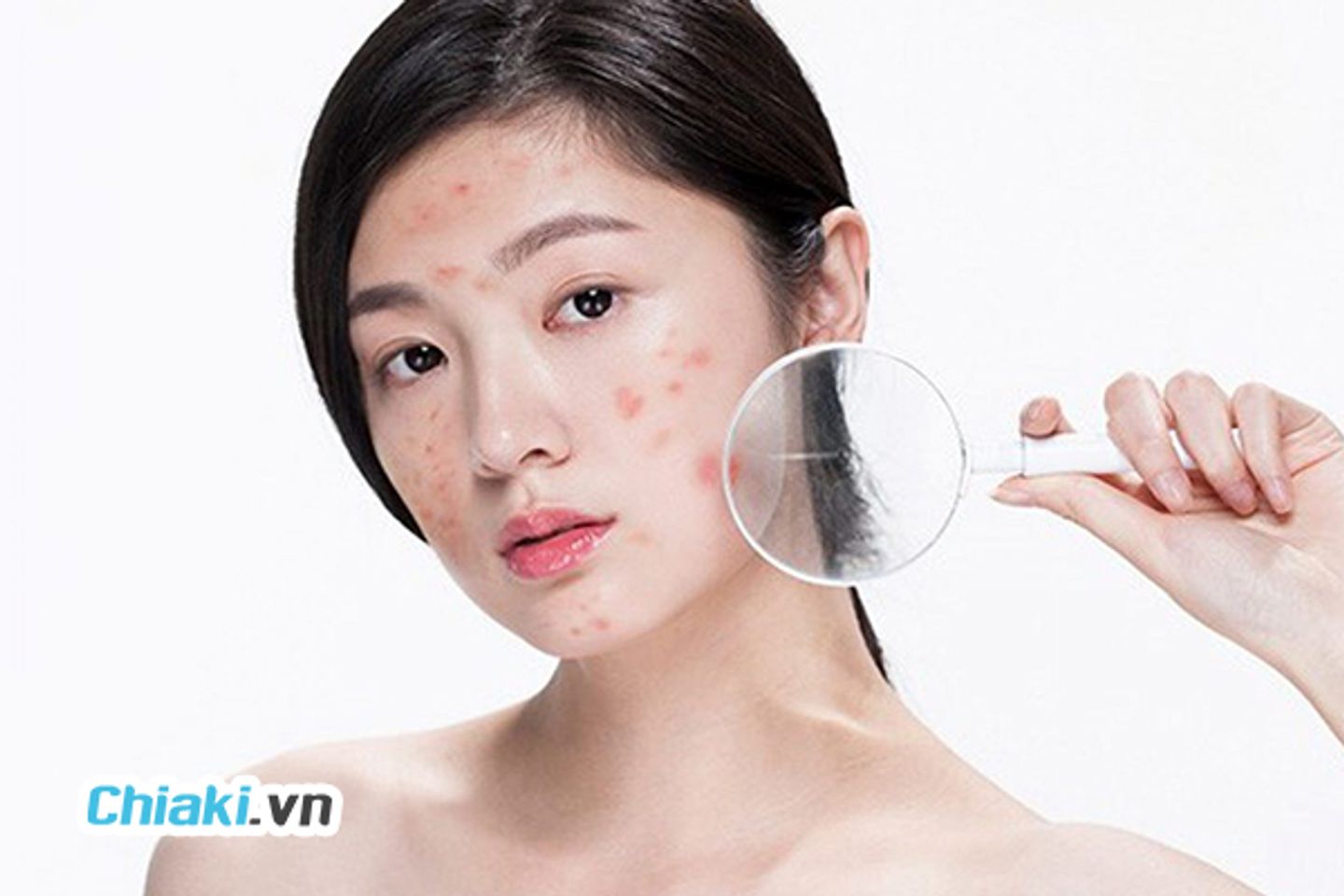 Top 10 Kem Trị Mụn Cho Tuổi Dậy Thì Tốt Hiện Nay