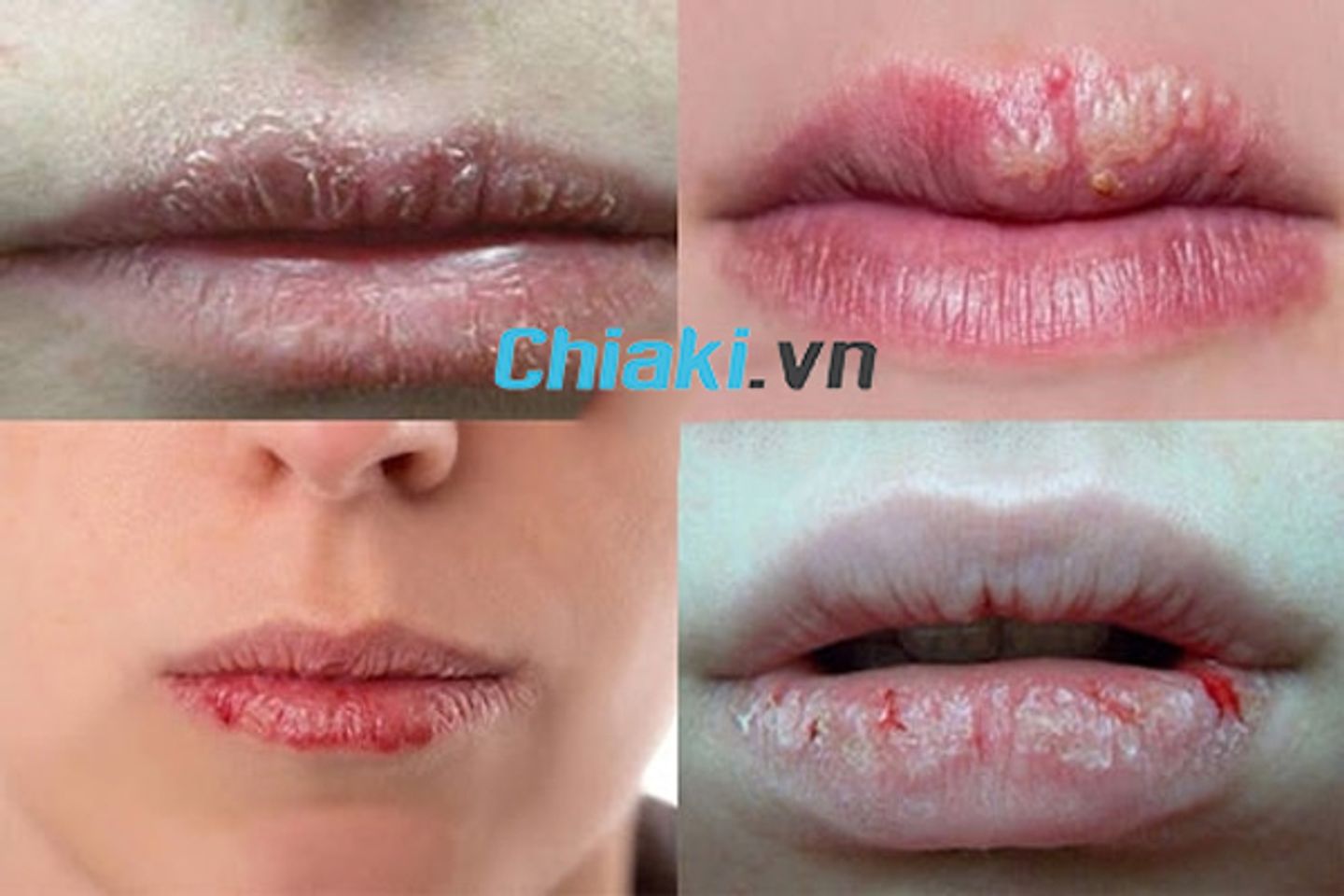 C&aacute;c biểu hiện m&ocirc;i bị dị ứng son