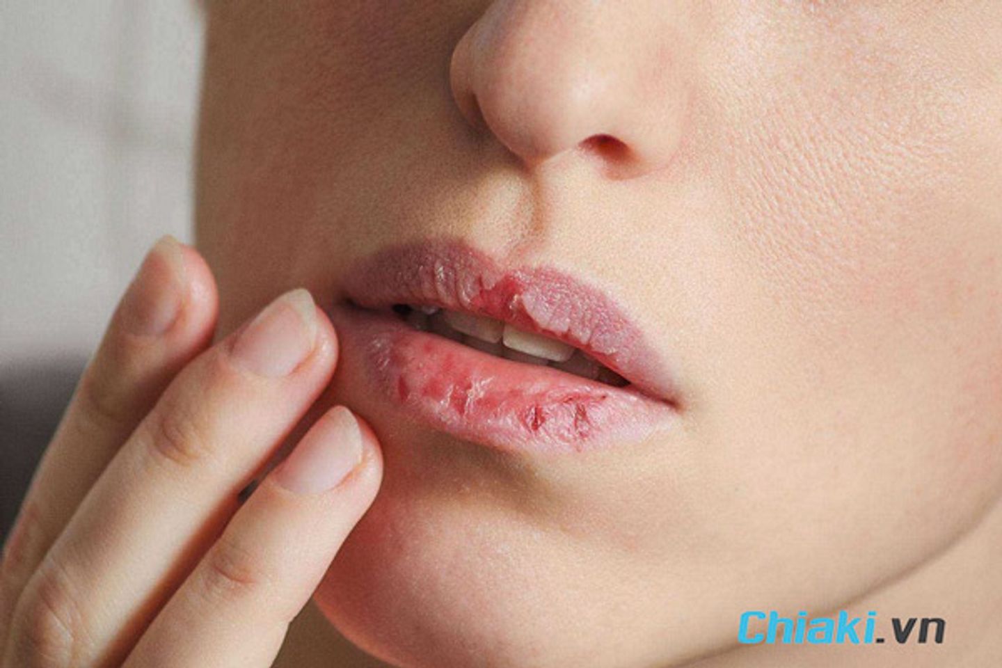 M&ocirc;i bị dị ứng son xảy ra khi tiếp x&uacute;c với c&aacute;c chất độc hại