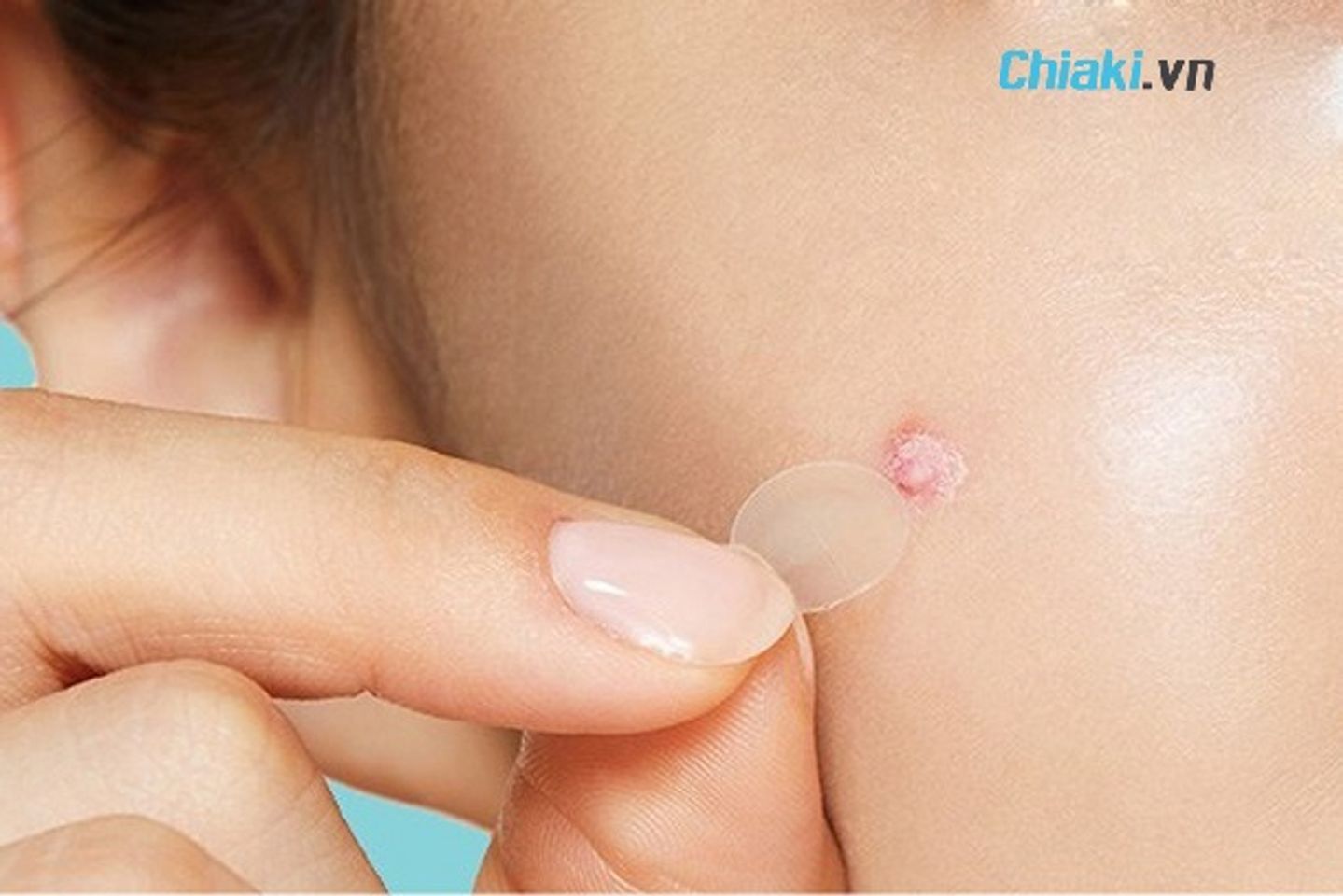 ưu &dstrok;iểm của miếng d&aacute;n mụn