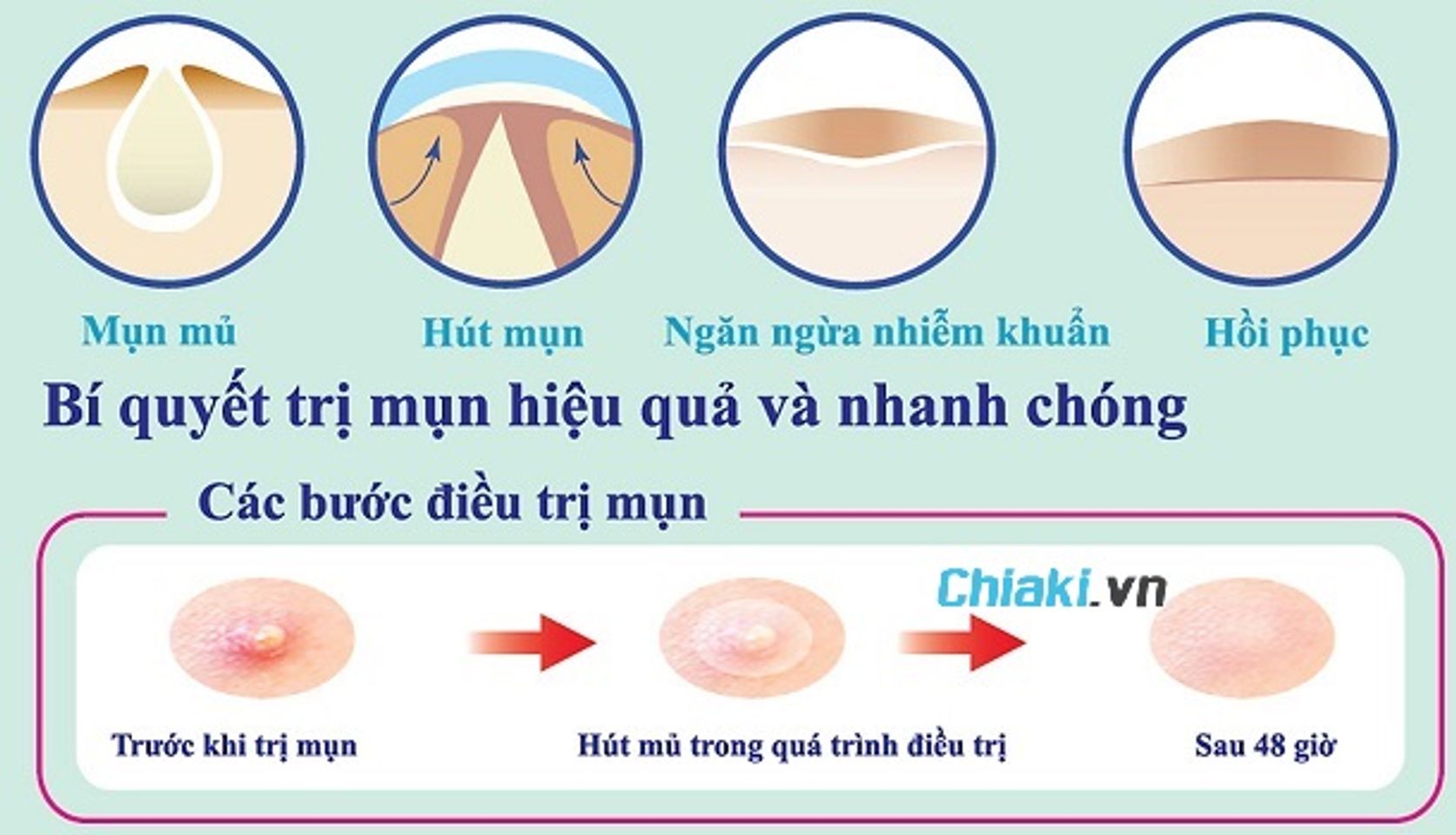 Sử dụng miếng d&aacute;n mụn c&oacute; hiệu quả kh&ocirc;ng?
