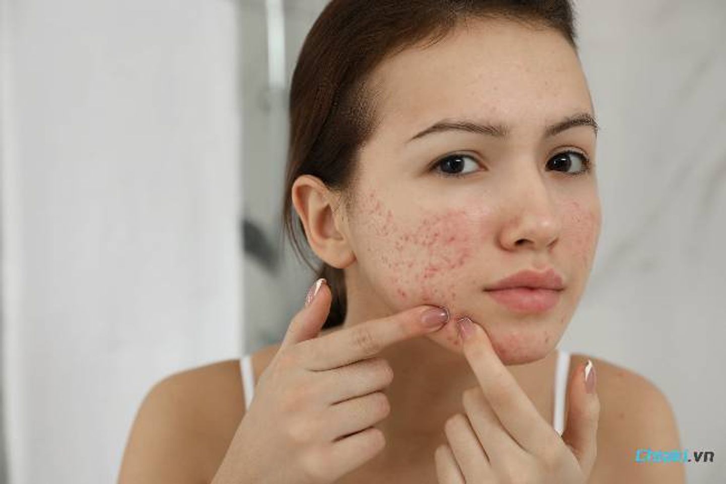 Nguy&ecirc;n nh&acirc;n h&igrave;nh th&agrave;nh sẹo rỗ tr&ecirc;n da mặt&nbsp;