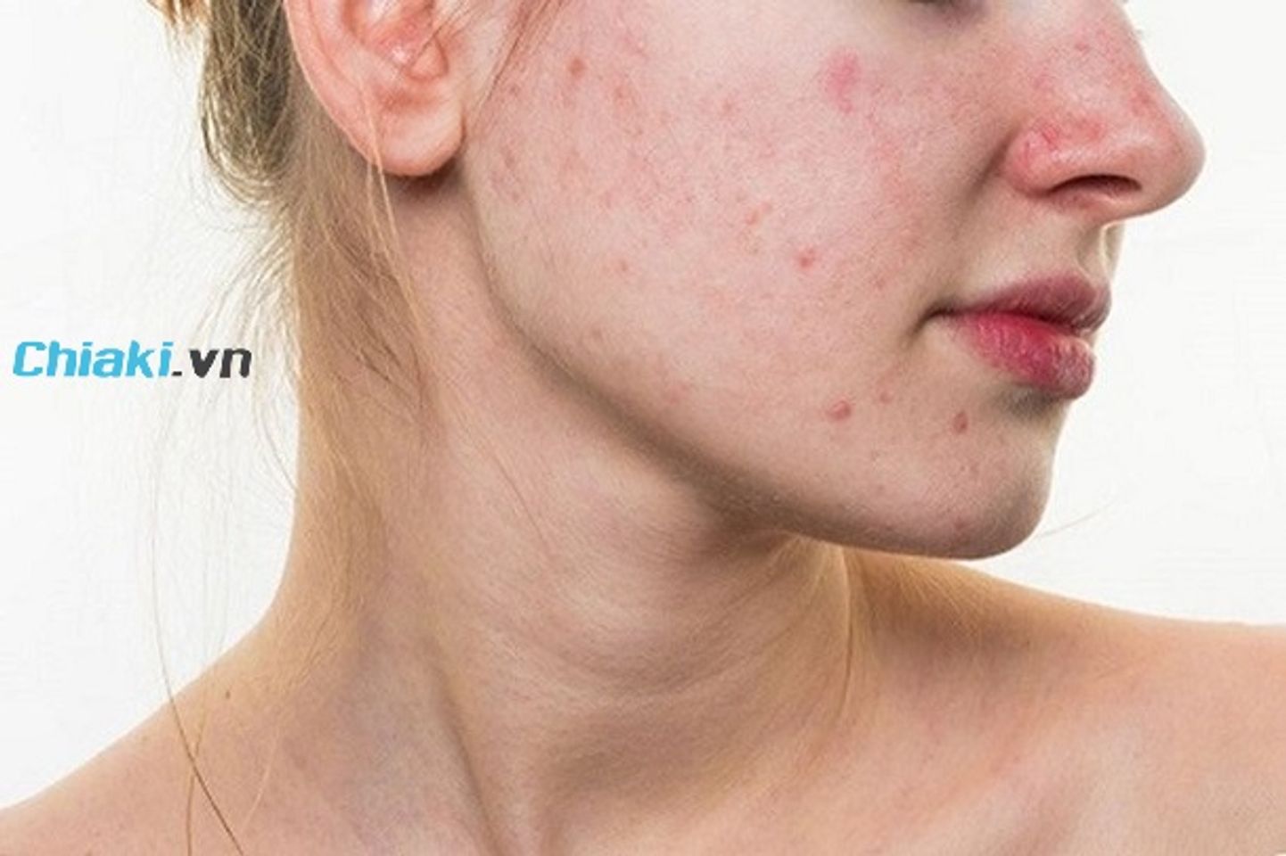 Đặc điểm của l&agrave;n da kh&ocirc; mụn