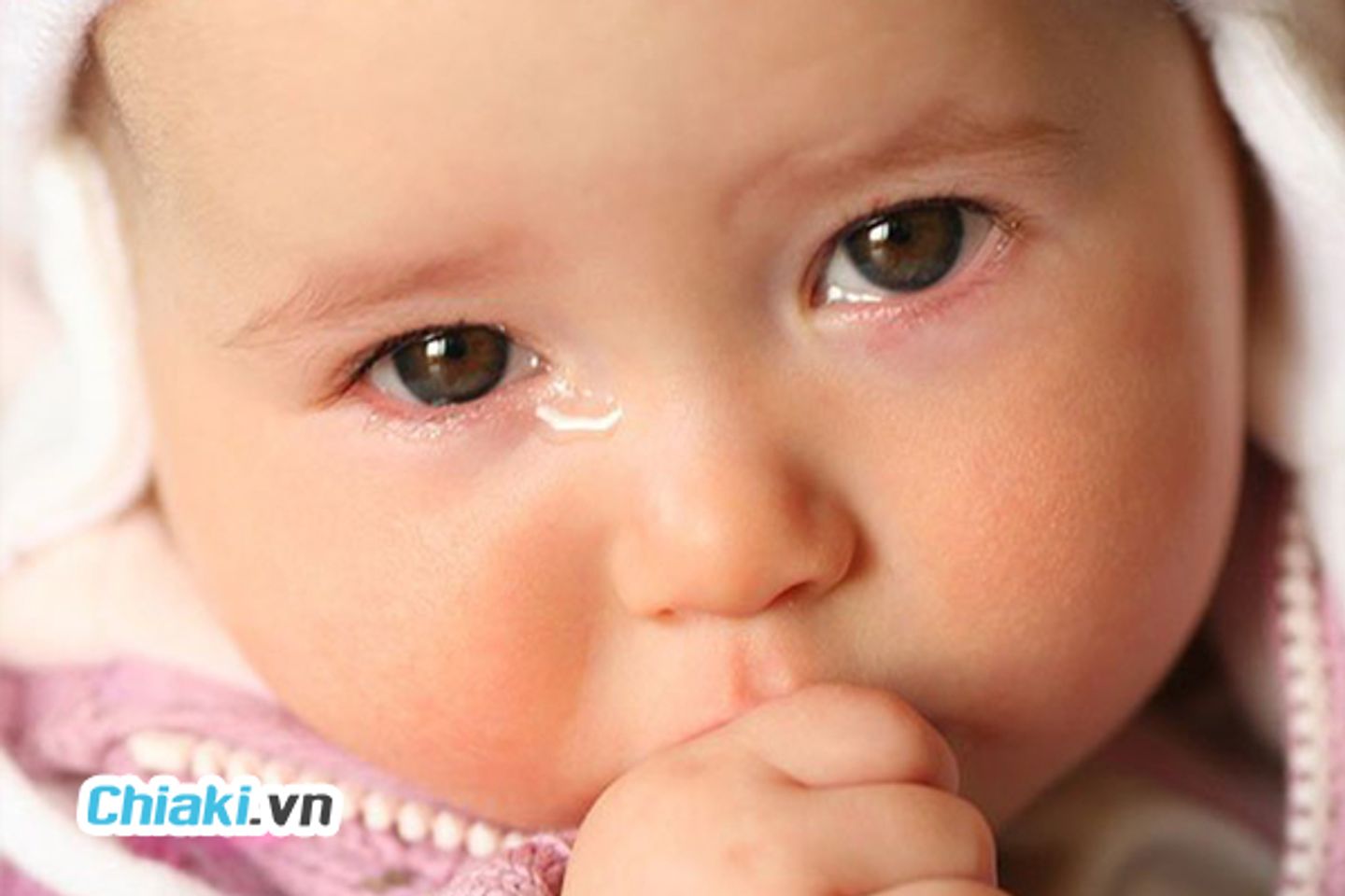 Tắc tuyến lệ khiến nước mắt kh&ocirc;ng thể dẫn lưu một c&aacute;ch b&igrave;nh thường
