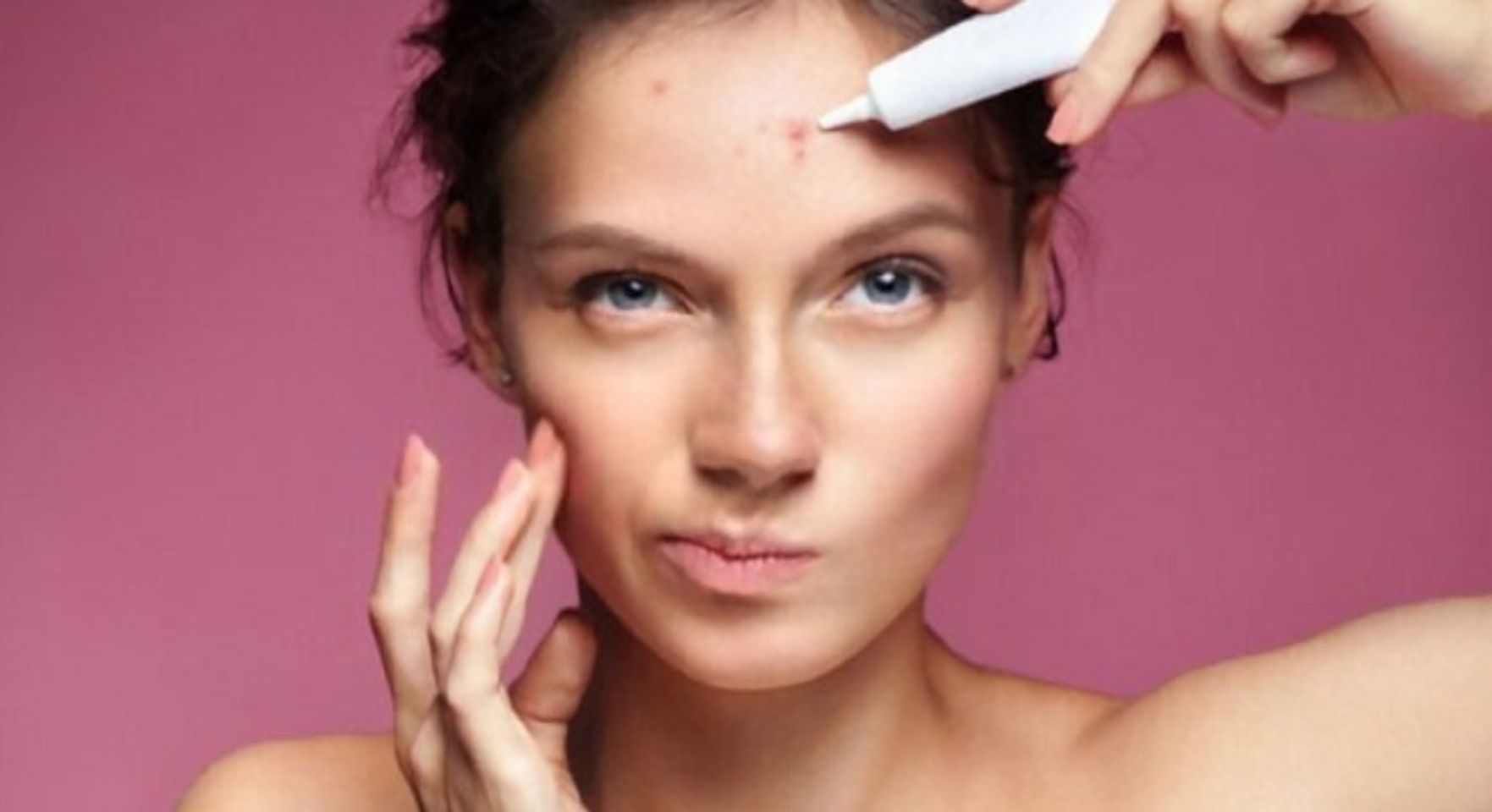 Tre gi&uacute;p cải thiện mụn tr&ecirc;n da