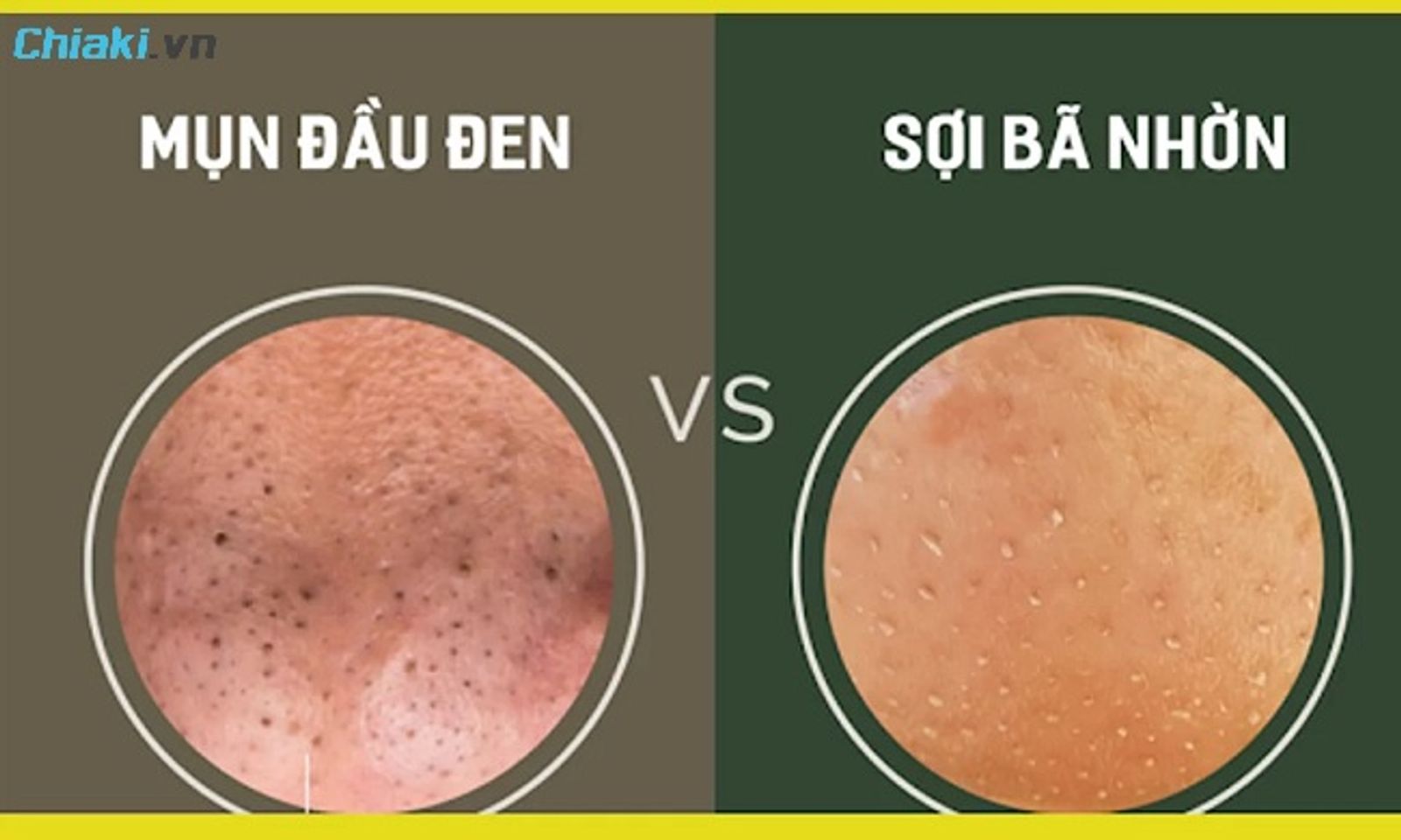Sợi b&atilde; nhờn mũi kh&aacute;c mụn đầu đen