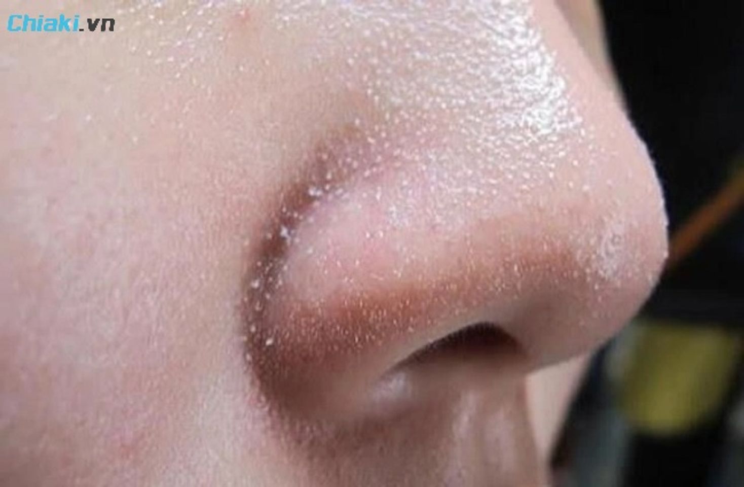 Sợi b&atilde; nhờn ở mũi l&agrave; một phần của l&agrave;n da, ch&uacute;ng được tạo n&ecirc;n nhờ v&agrave;o c&aacute;c tuyến b&atilde; nhờn, lipid b&atilde; nhờn, vi khuẩn v&agrave; cả c&aacute;c tế b&agrave;o chết