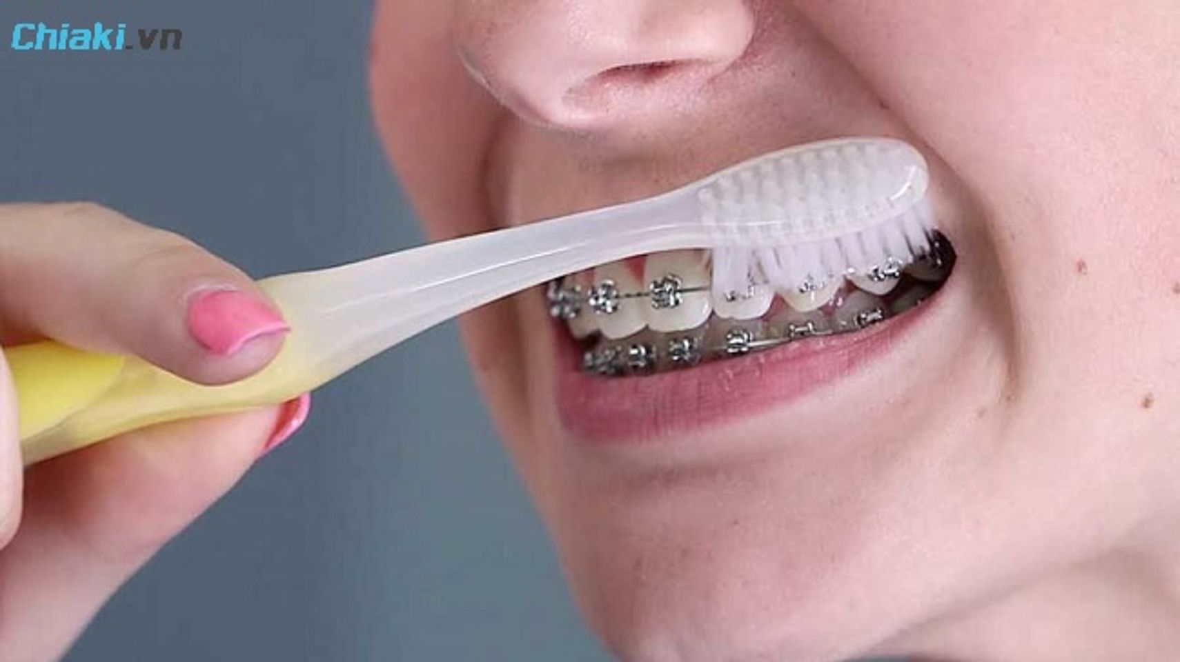 Top 10 Kem đánh răng cho người niềng răng được nha sĩ khuyên dùng 2026