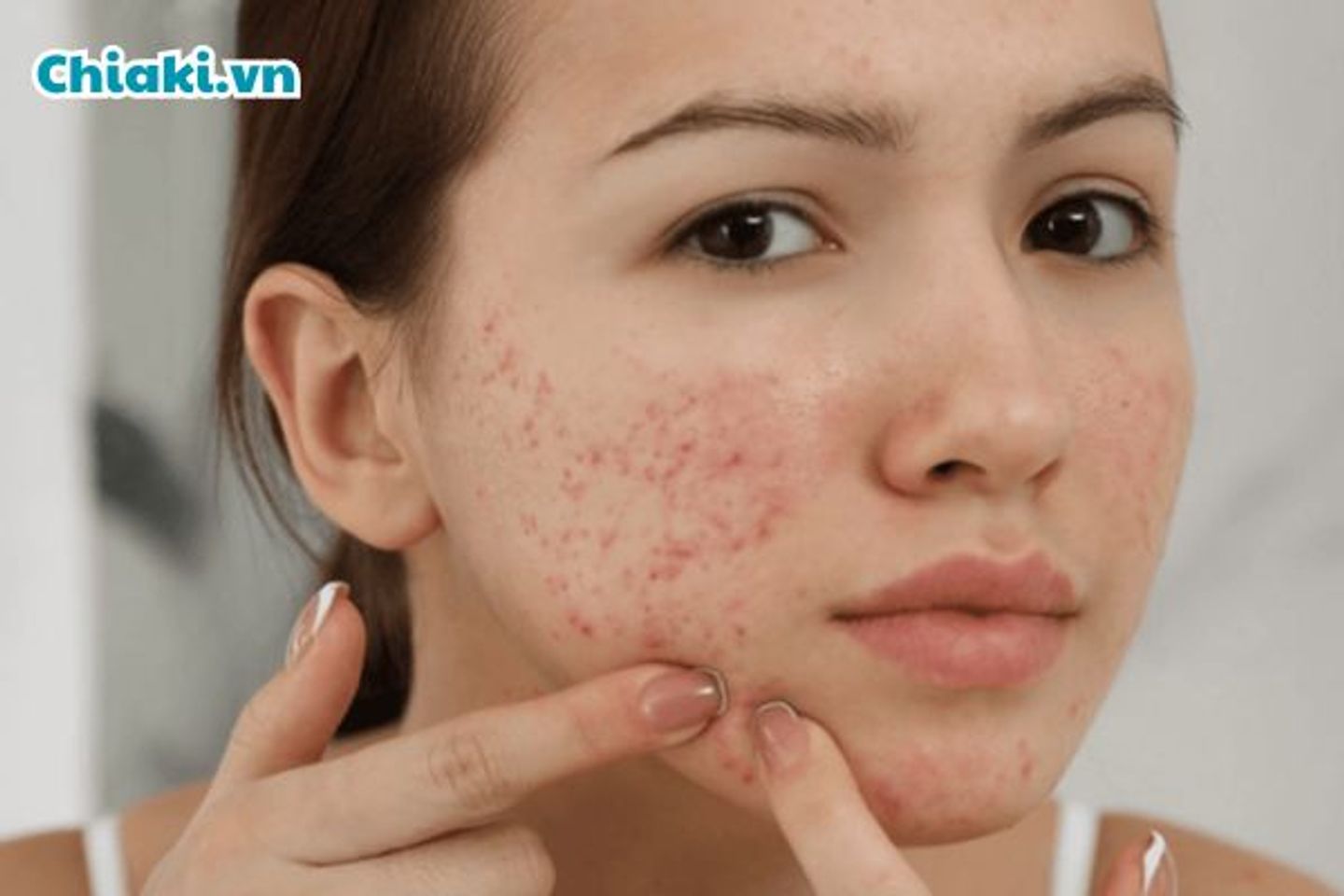 Uống Whey nổi mụn kh&ocirc;ng?