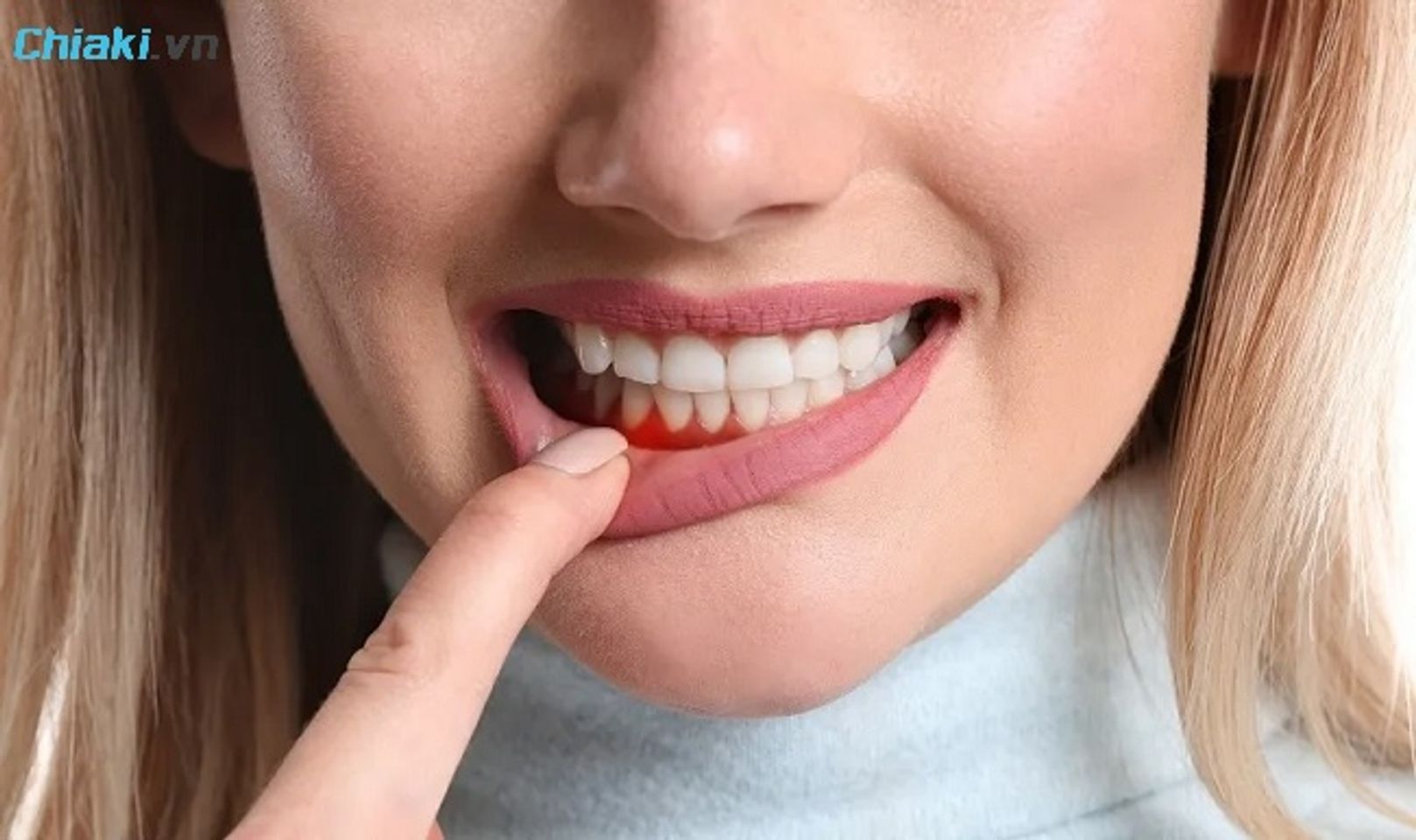 Vi&ecirc;m nướu do mảng b&aacute;m c&oacute; chứa vi khuẩn t&iacute;ch tụ l&acirc;u tr&ecirc;n răng g&acirc;y vi&ecirc;m m&ocirc; nướu