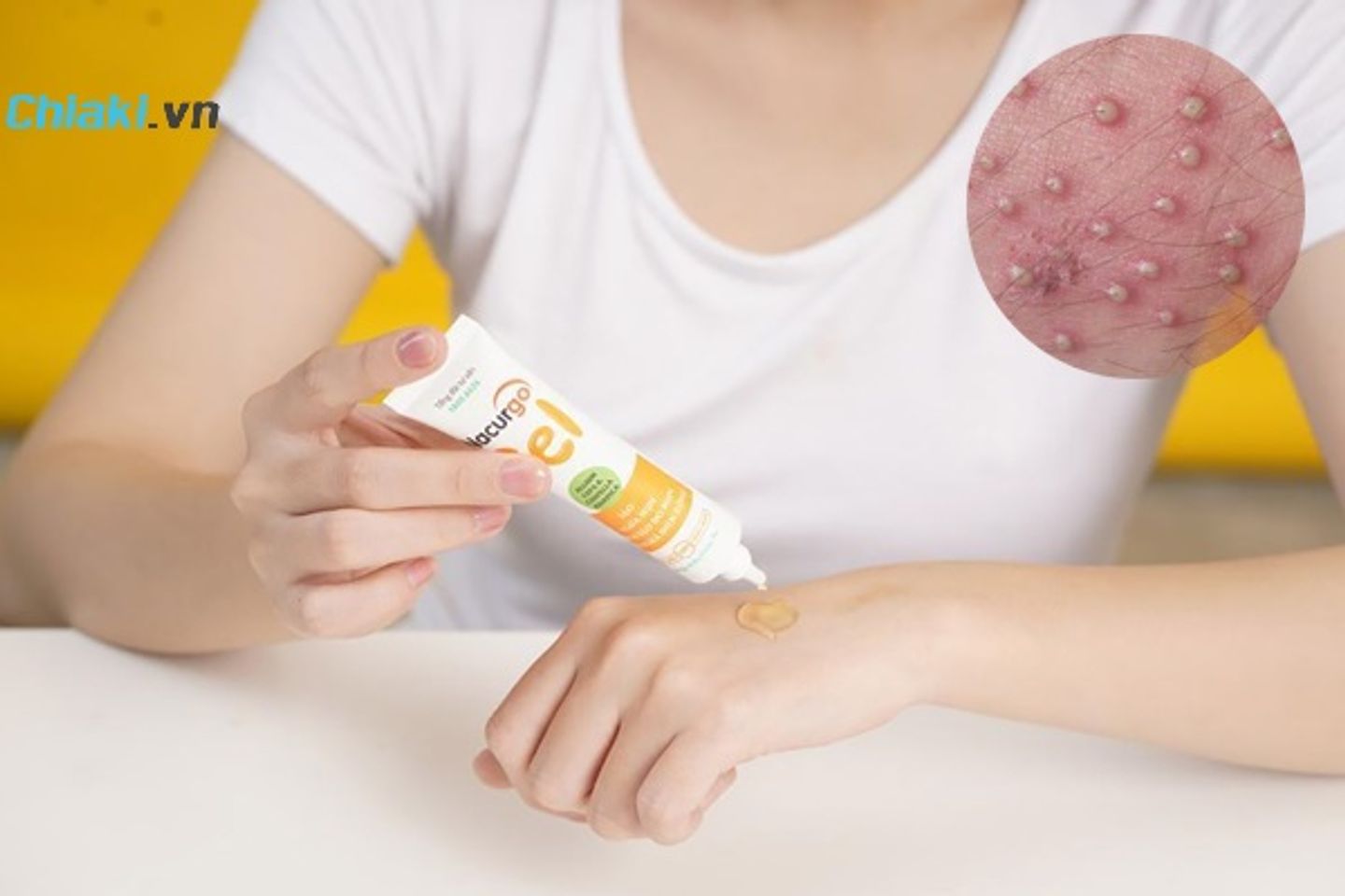 C&aacute;ch sử dụng kem trị vi&ecirc;m nang l&ocirc;ng