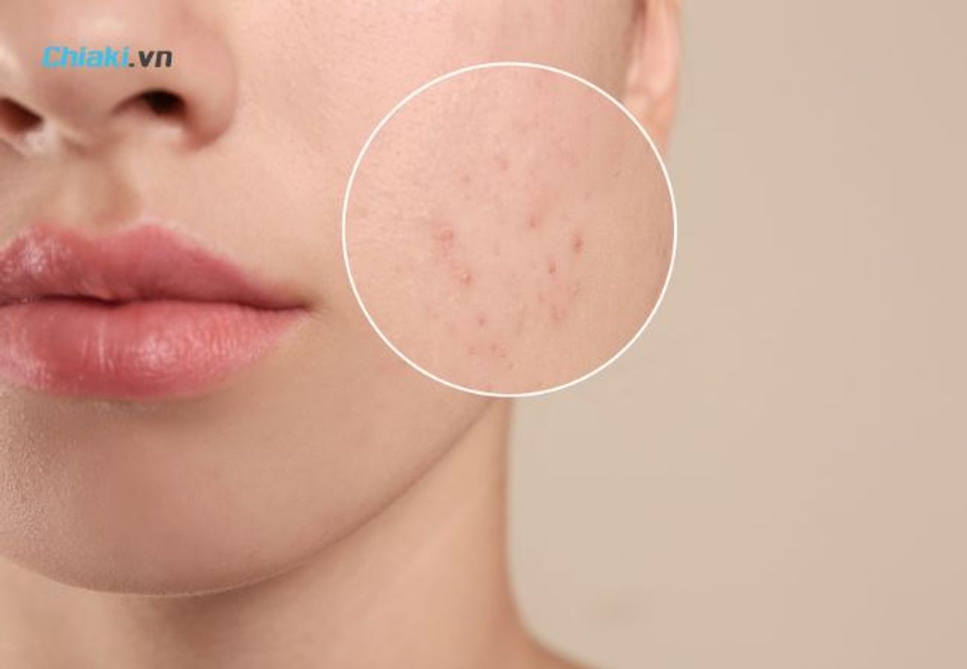 X&ocirc;ng mặt gi&uacute;p giảm mụn ẩn v&agrave; mụn đầu đen