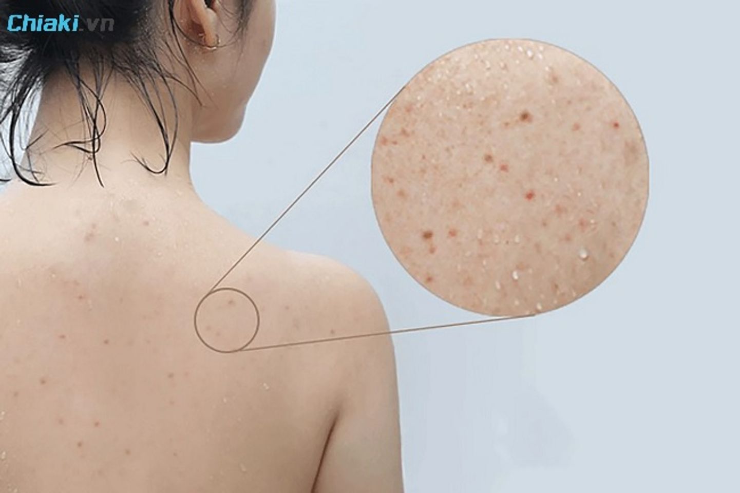 Mụn lưng do nhiều nguy&ecirc;n nh&acirc;n g&acirc;y n&ecirc;n