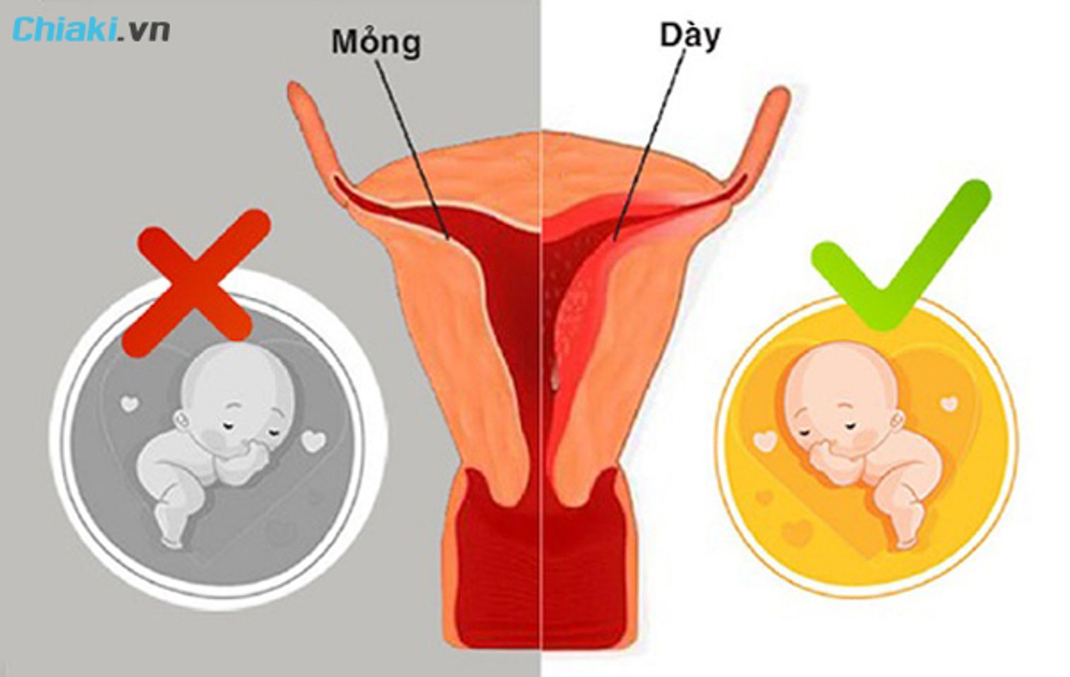 ni&ecirc;m mạc tử cung ảnh hưởng đến khả năng mang thai