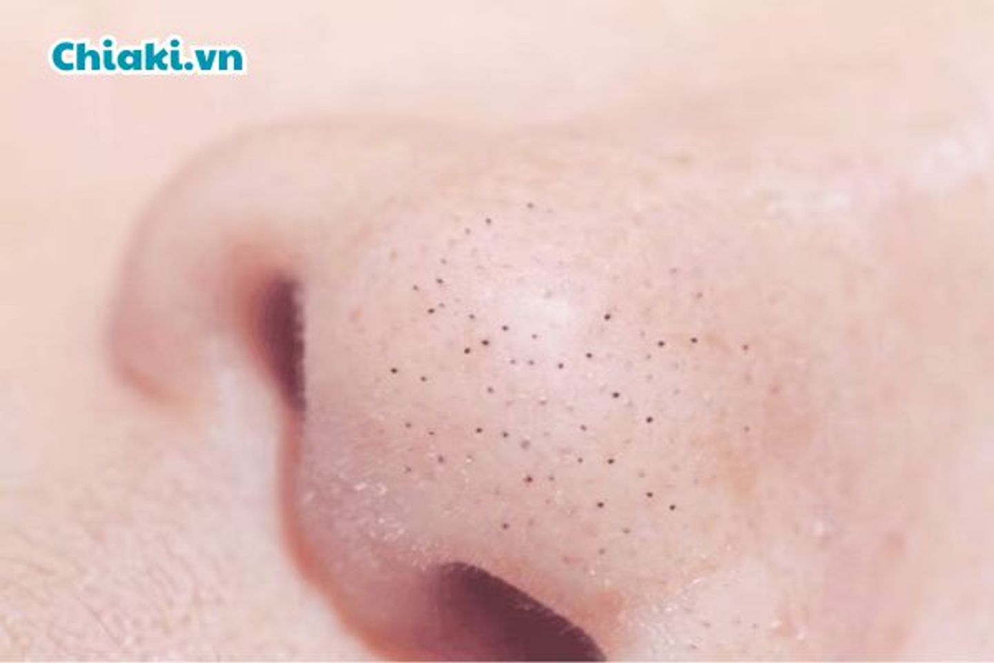 Nguy&ecirc;n nh&acirc;n bị mụn đầu đen l&agrave; g&igrave;?