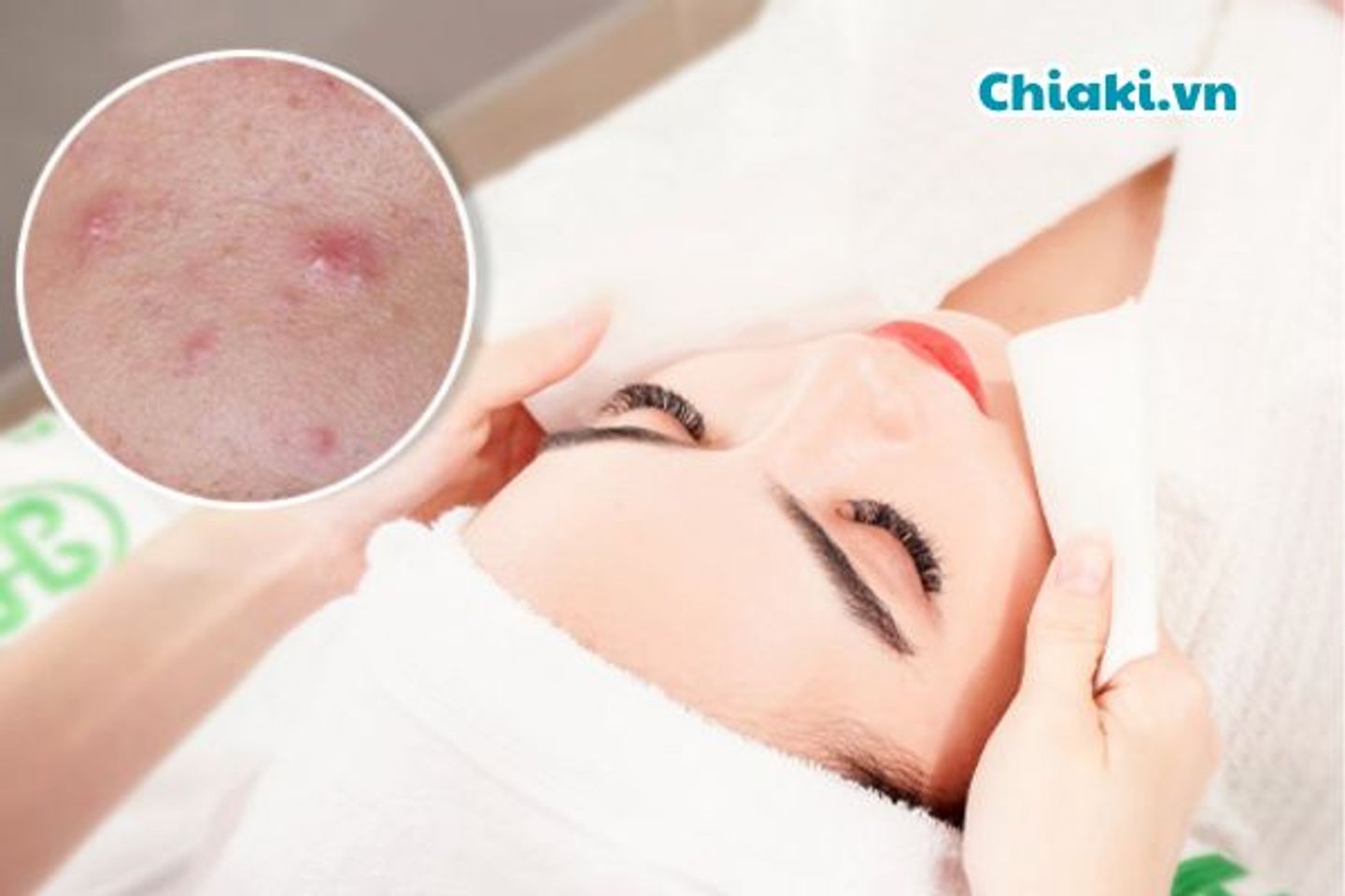 C&aacute;ch chăm s&oacute;c da ngừa mụn đầu đen