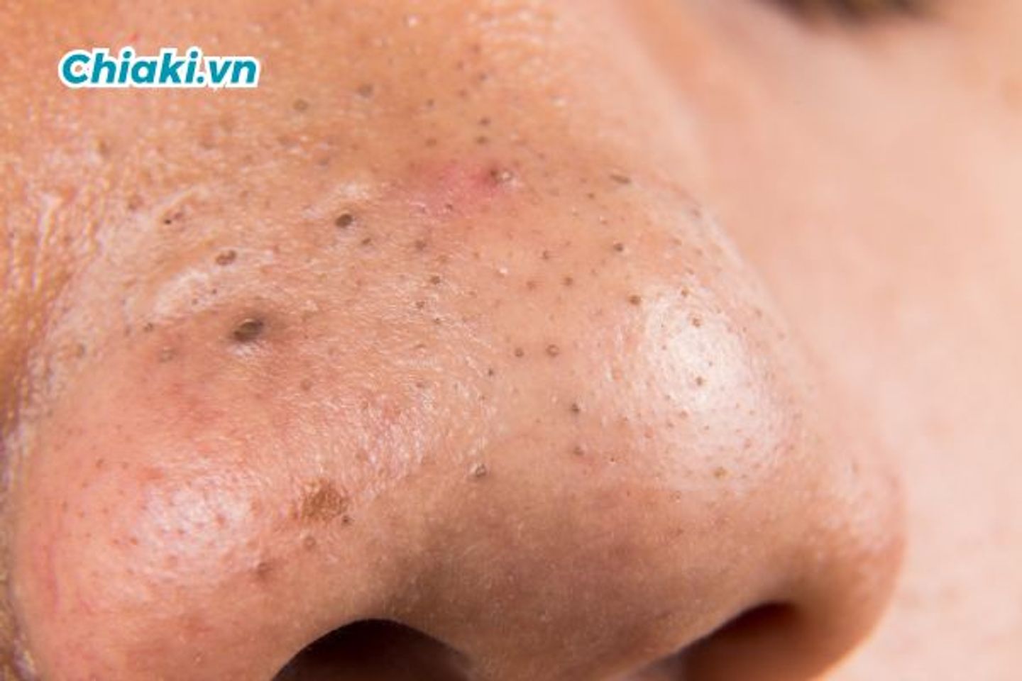 Nguy&ecirc;n nh&acirc;n bị mụn đen