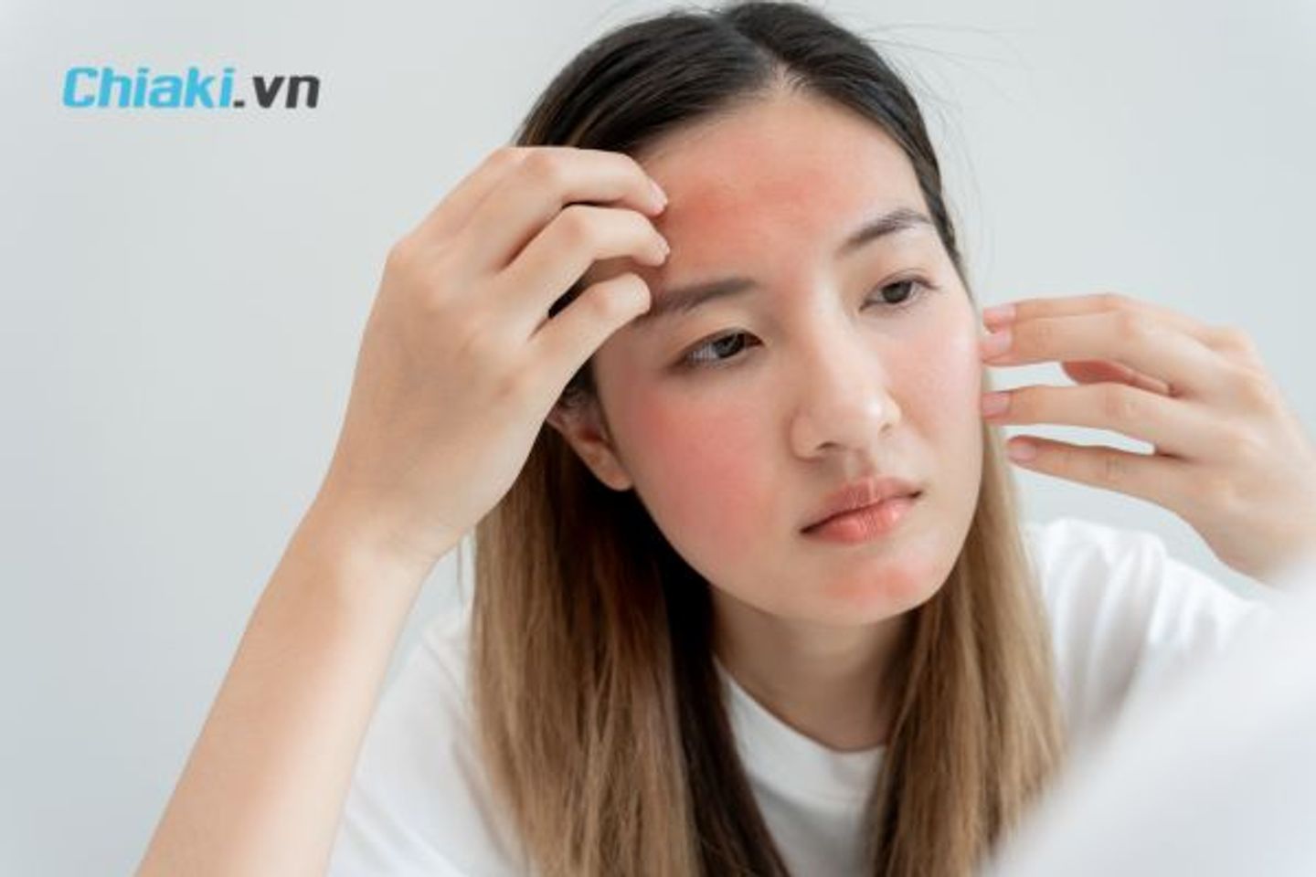 Vi&ecirc;m da cơ địa l&agrave; g&igrave;?