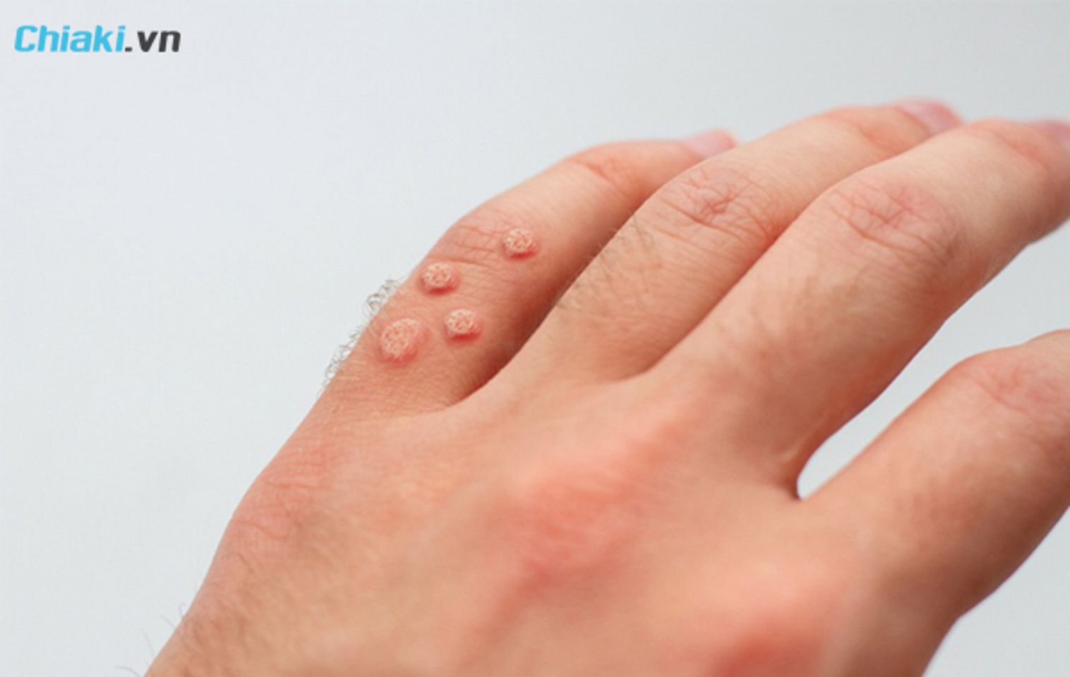 Khi n&agrave;o mụn c&oacute;c cần phải điều trị