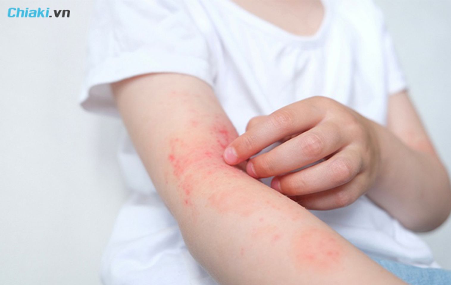 giới thiệu về t&igrave;nh trạng da dị ứng mẩn ngứa