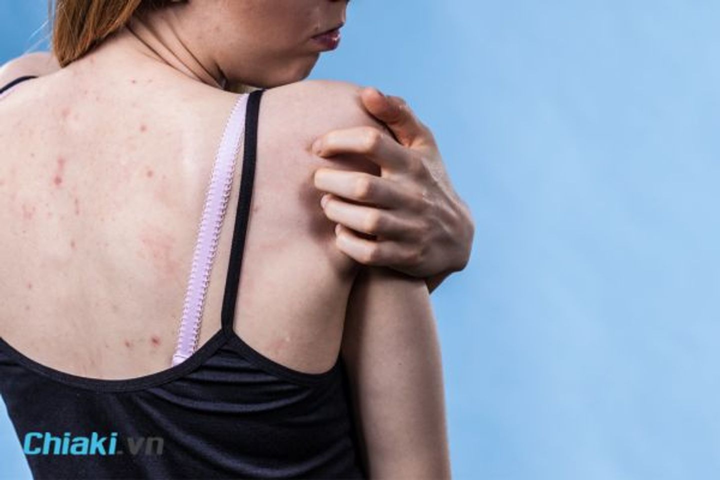 Nguy&ecirc;n nh&acirc;n bị mụn lưng l&agrave; g&igrave;?