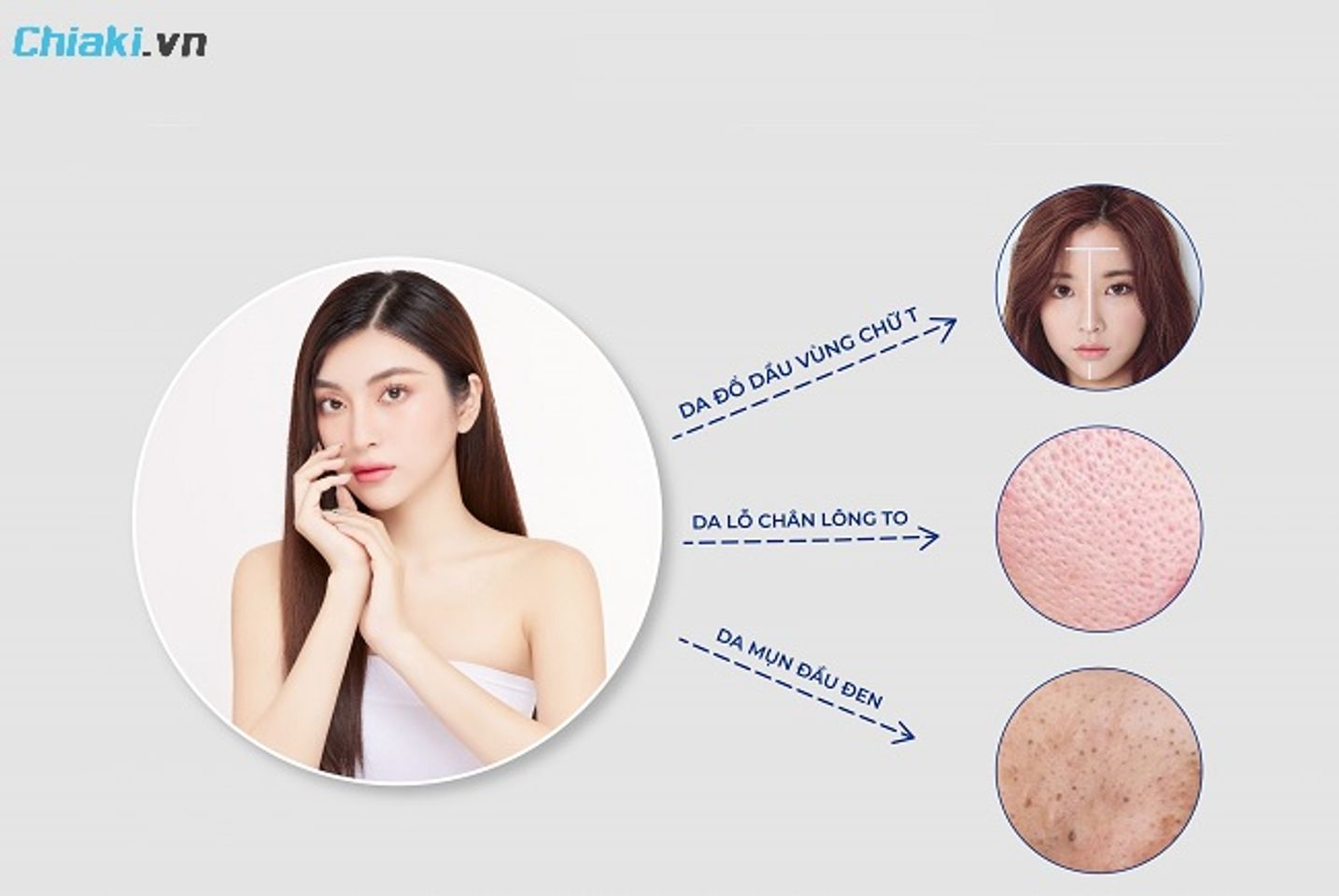 Da dầu thường b&oacute;ng nhờn, lỗ ch&acirc;n l&ocirc;ng to, xuất hiện mụn