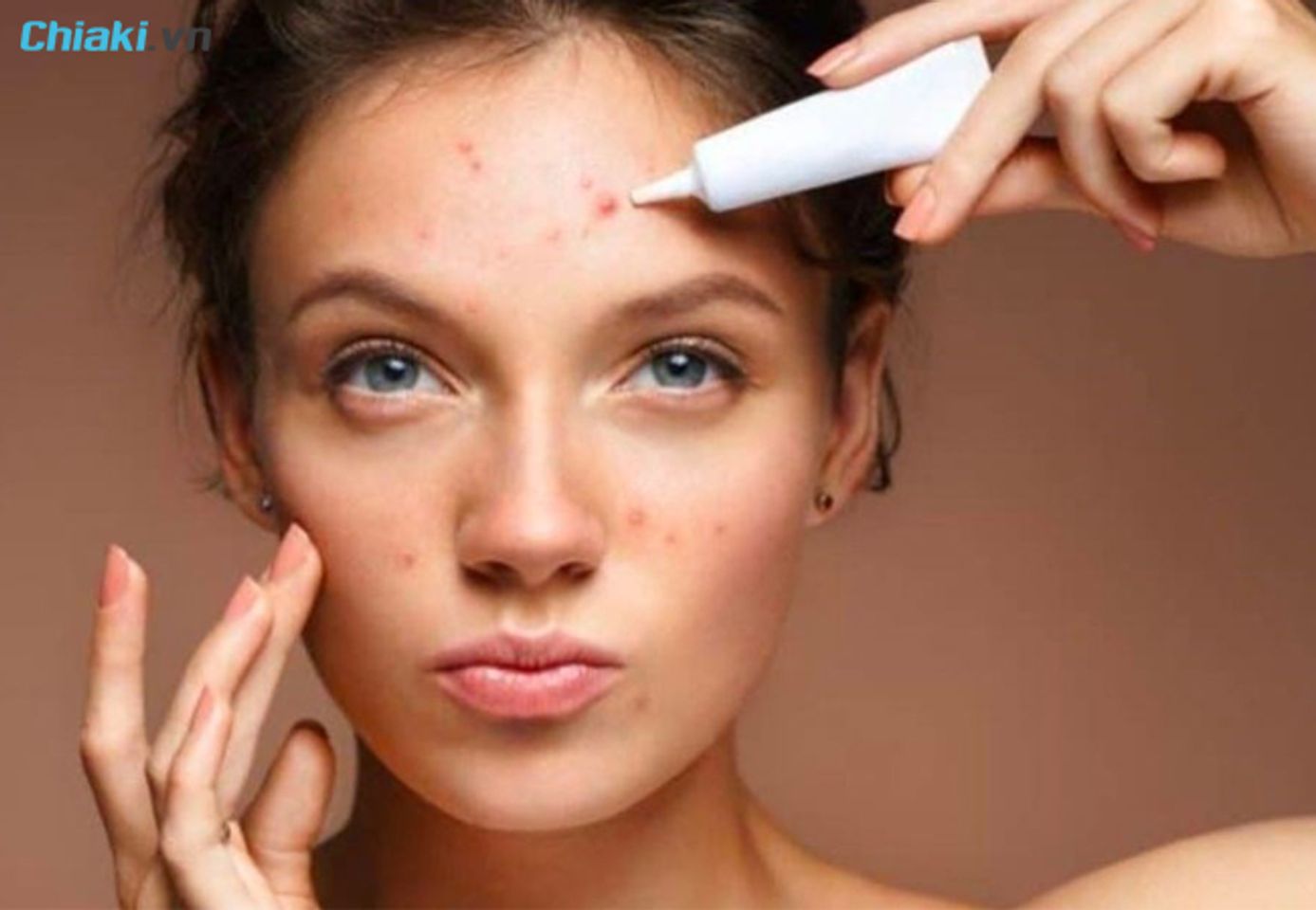 Điều trị mụn vi&ecirc;m bằng thuốc kh&ocirc;ng k&ecirc; đơn