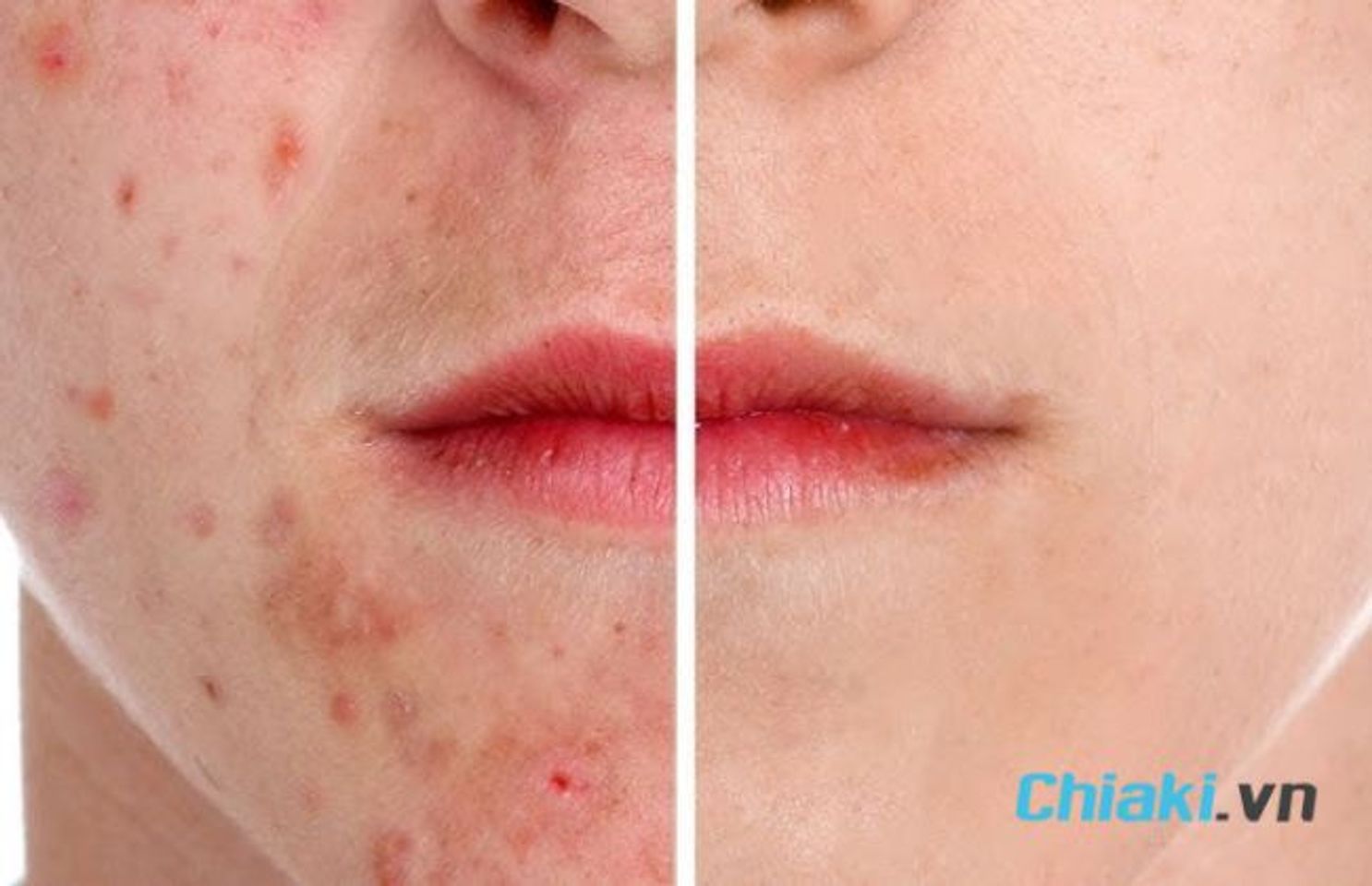 Glycolic Acid trị mụn trứng c&aacute;