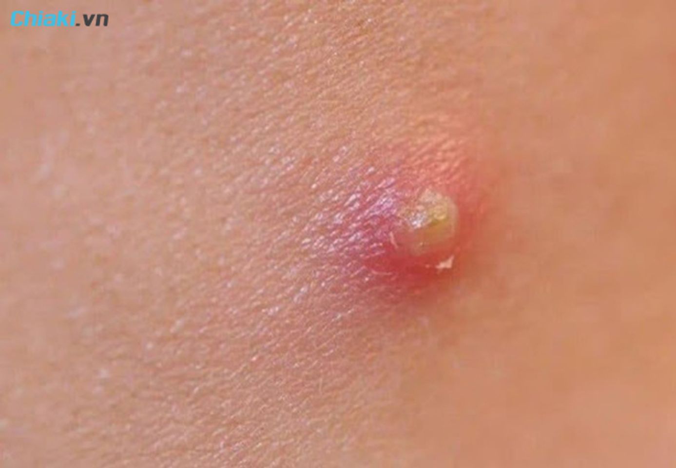 Mụn bọc g&acirc;y đau nhức 