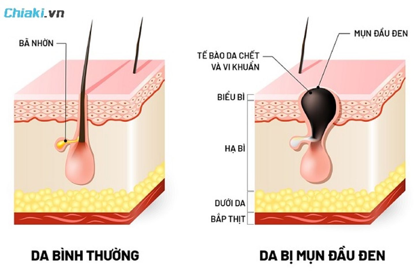 Mụn đầu đen thường xuất hiện ở v&ugrave;ng chữ T, c&oacute; m&agrave;u đen hoặc x&aacute;m đen