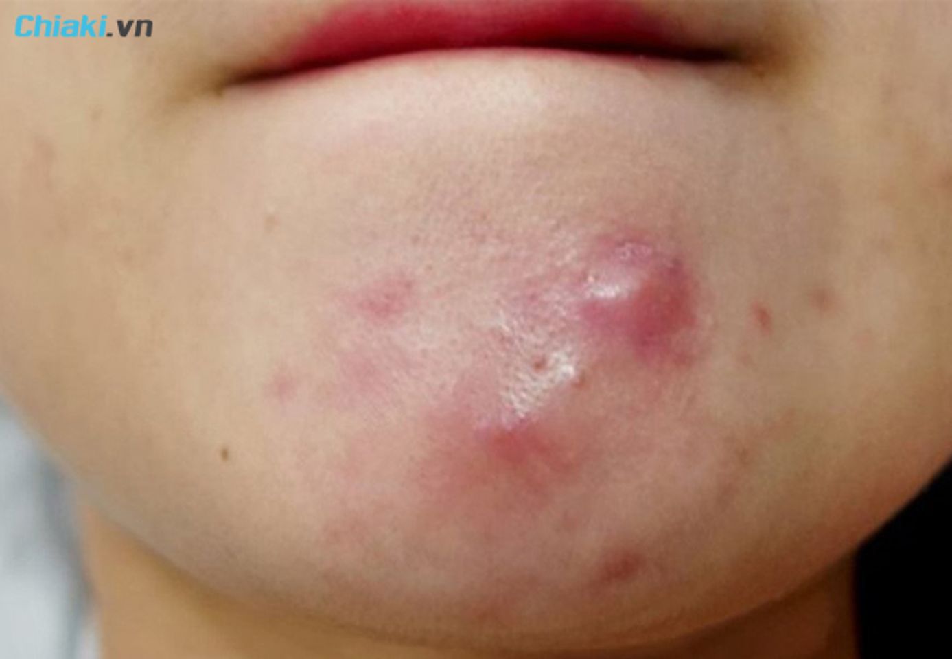 Mụn nang c&oacute; c&aacute;c ổ mụn to