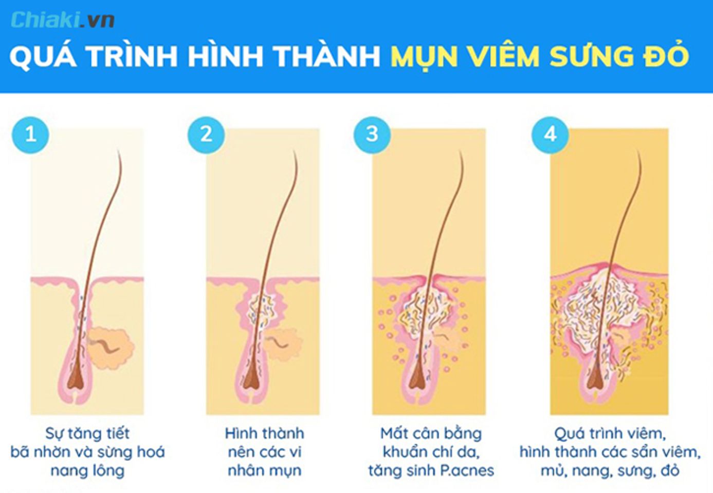 qu&aacute; tr&igrave;nh h&igrave;nh th&agrave;nh mụn vi&ecirc;m