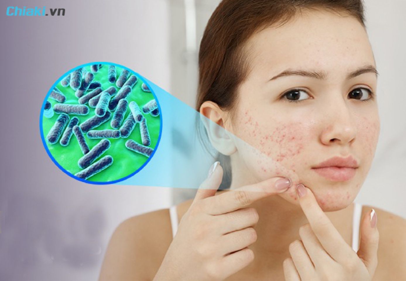 Nguy&ecirc;n nh&acirc;n g&acirc;y ra mụn vi&ecirc;m